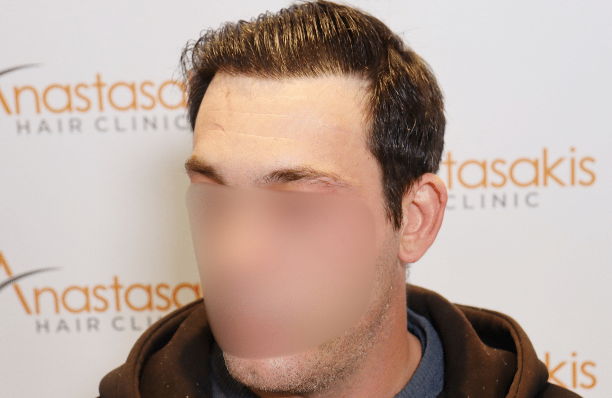 hair transplant result 1800 fus frontal thick