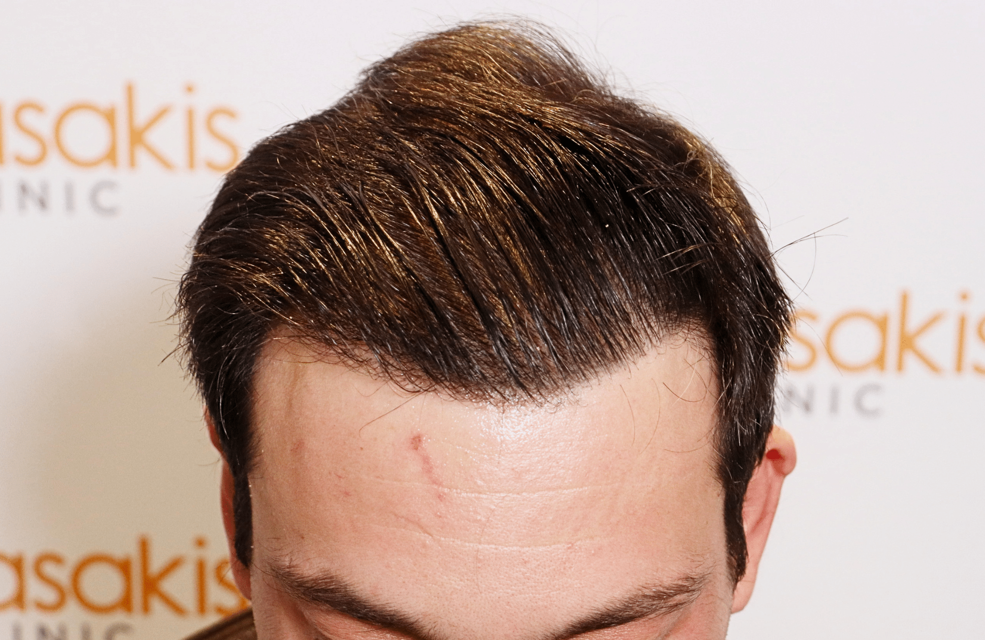 hair transplant result 1800 fus frontal thick