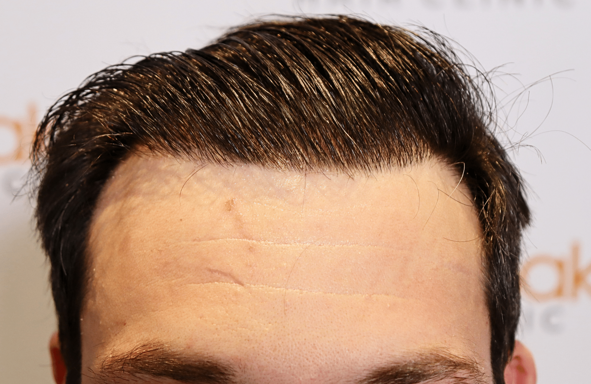 hair transplant result 1800 fus frontal thick