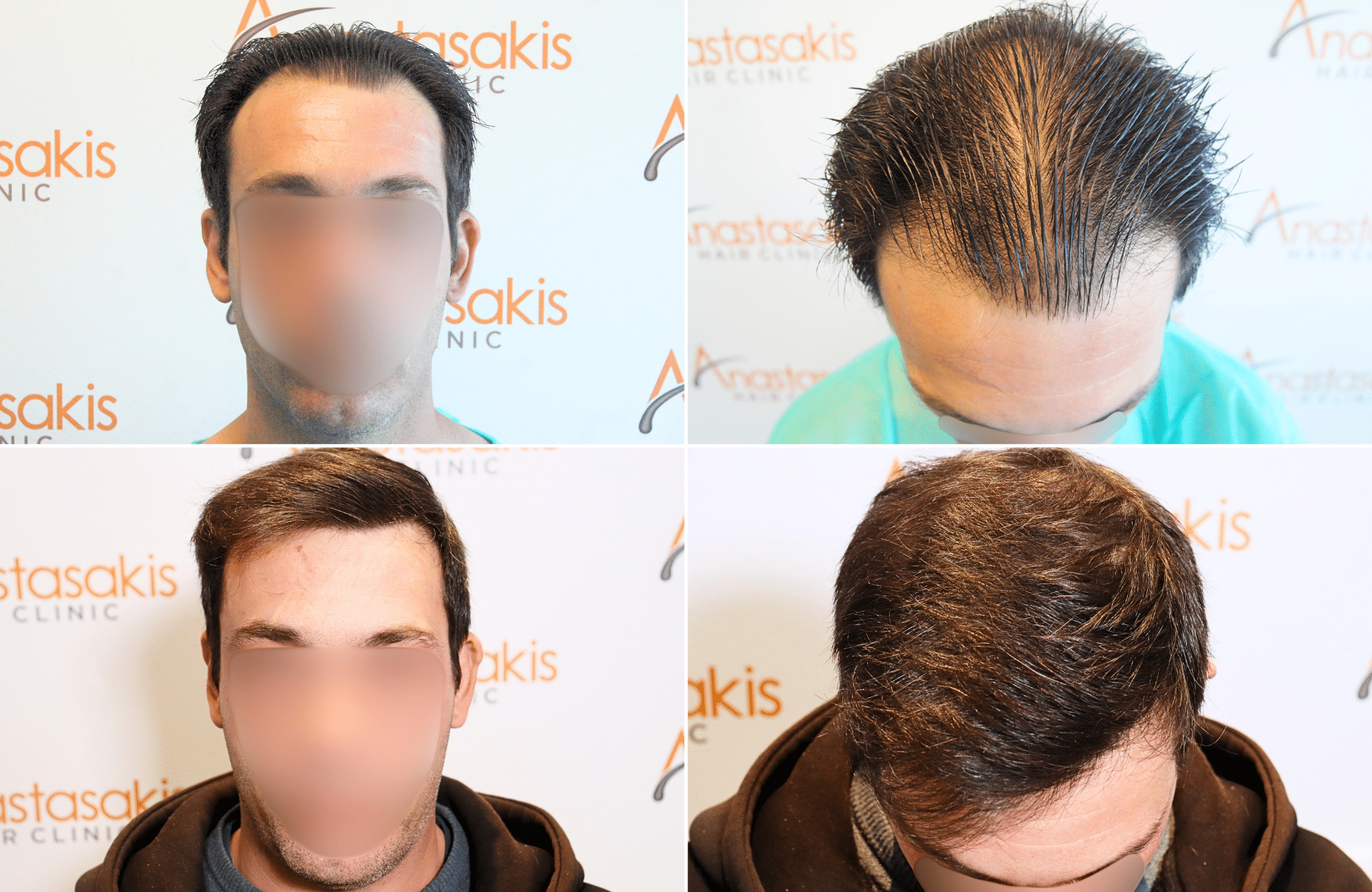 https://www.anastasakishairclinic.gr/portfolio/apotelesma-metamosxefsis-mallion-anastasakis-hair-clinic-221/
