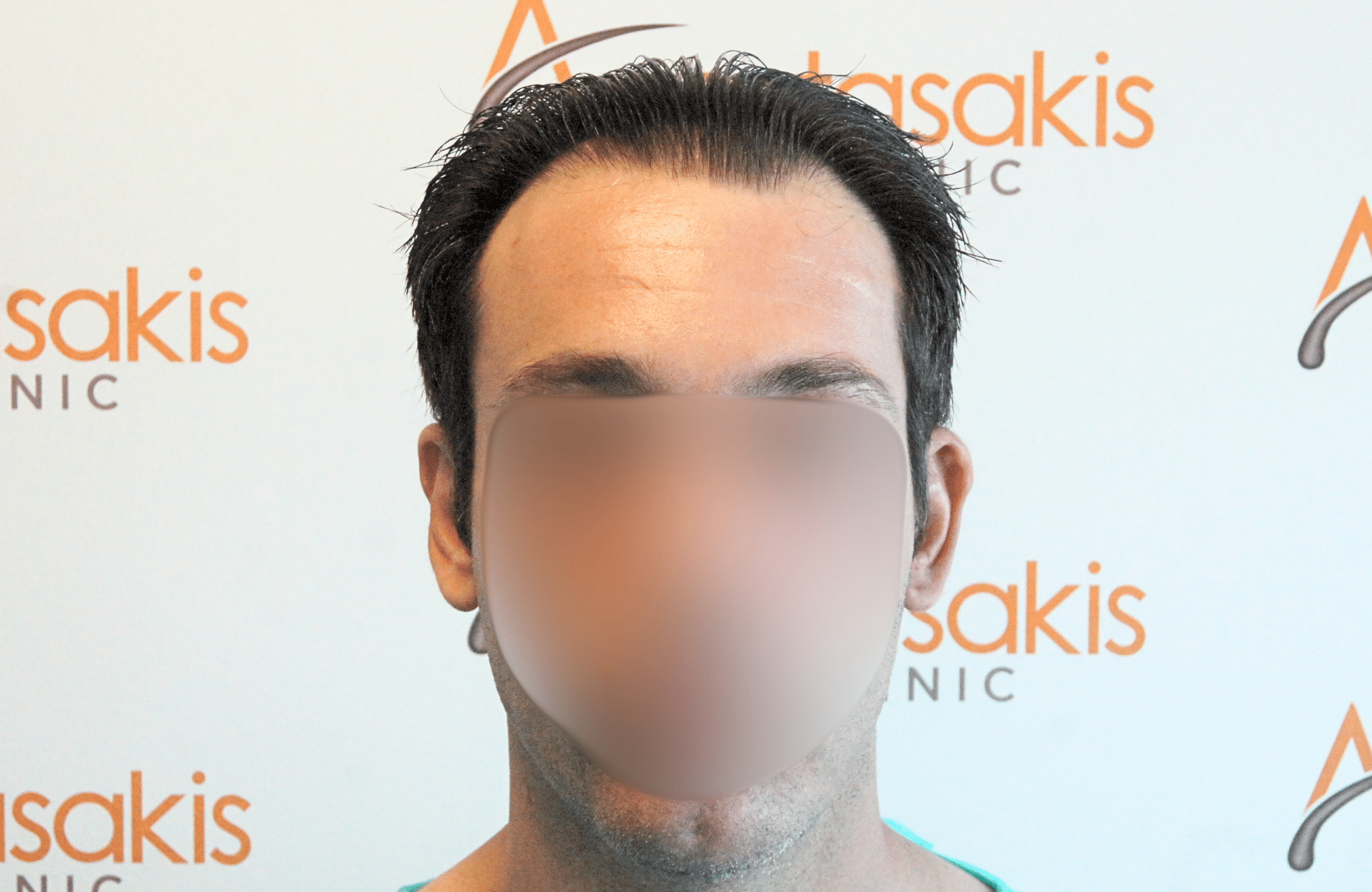 hair transplant result 1800 fus frontal thick