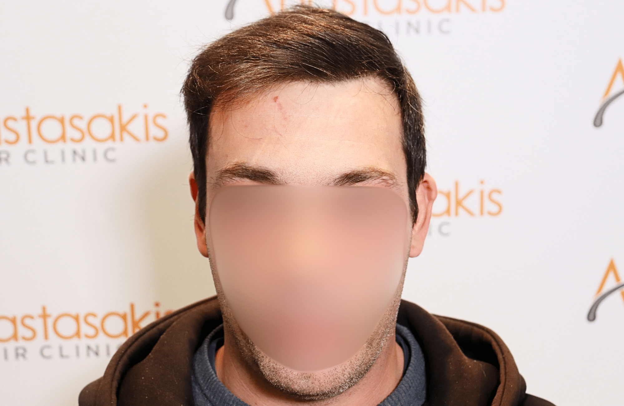 hair transplant result 1800 fus frontal thick