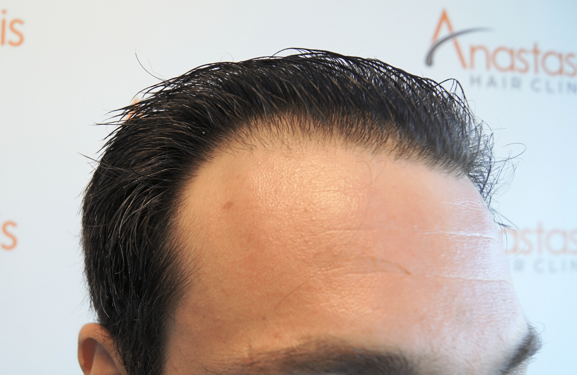 hair transplant result 1800 fus frontal thick