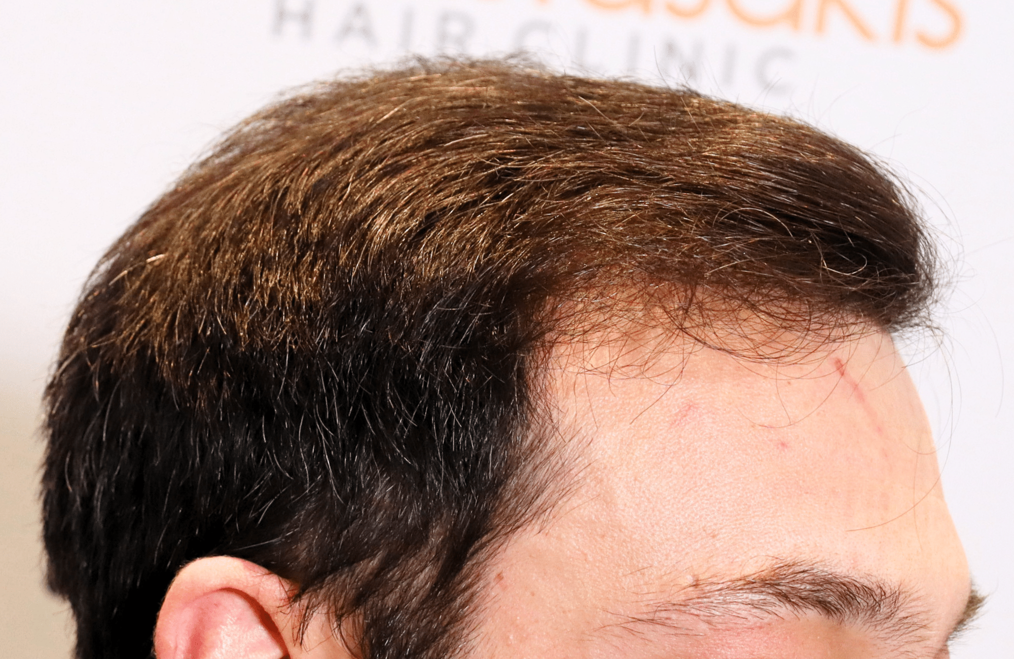 hair transplant result 1800 fus frontal thick