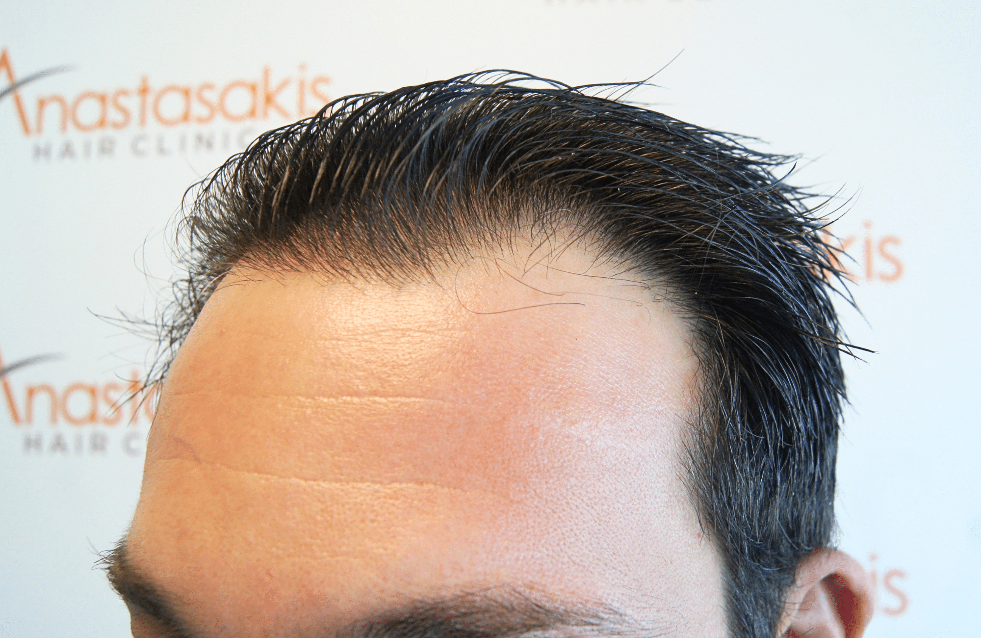hair transplant result 1800 fus frontal thick