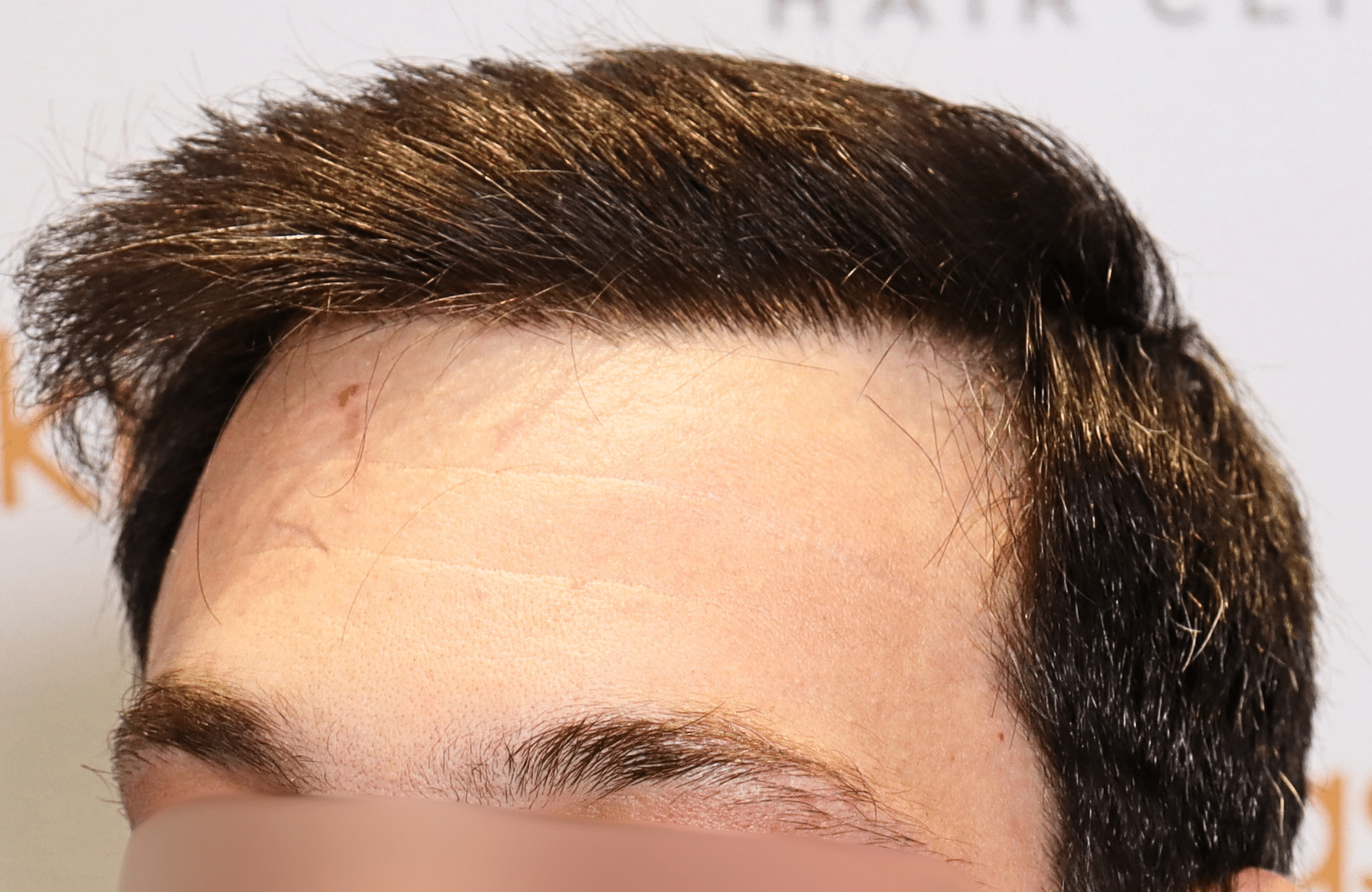 hair transplant result 1800 fus frontal thick