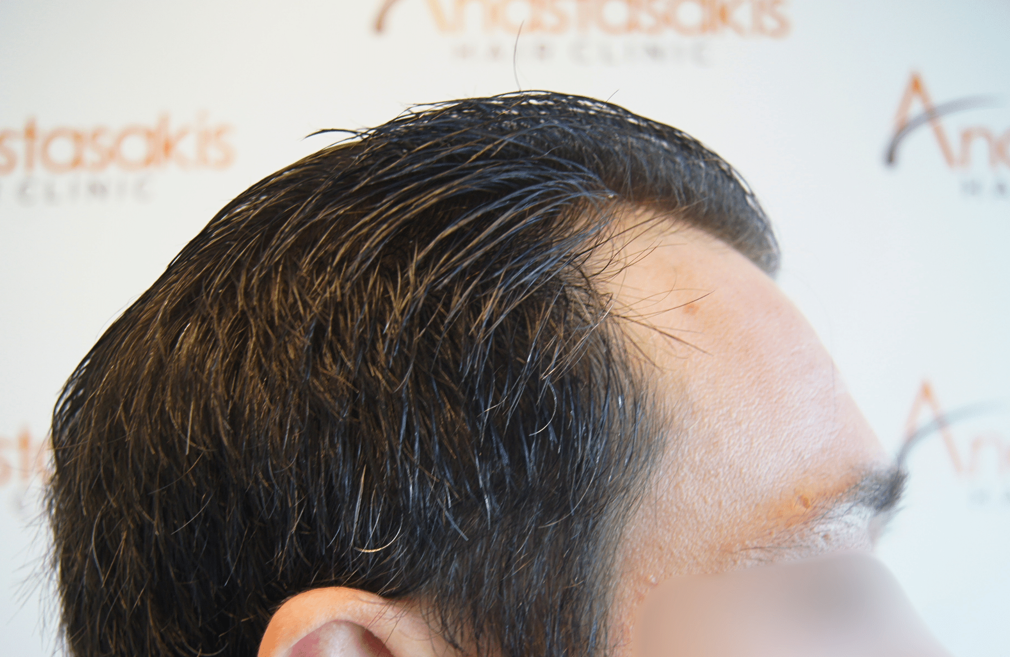 hair transplant result 1800 fus frontal thick