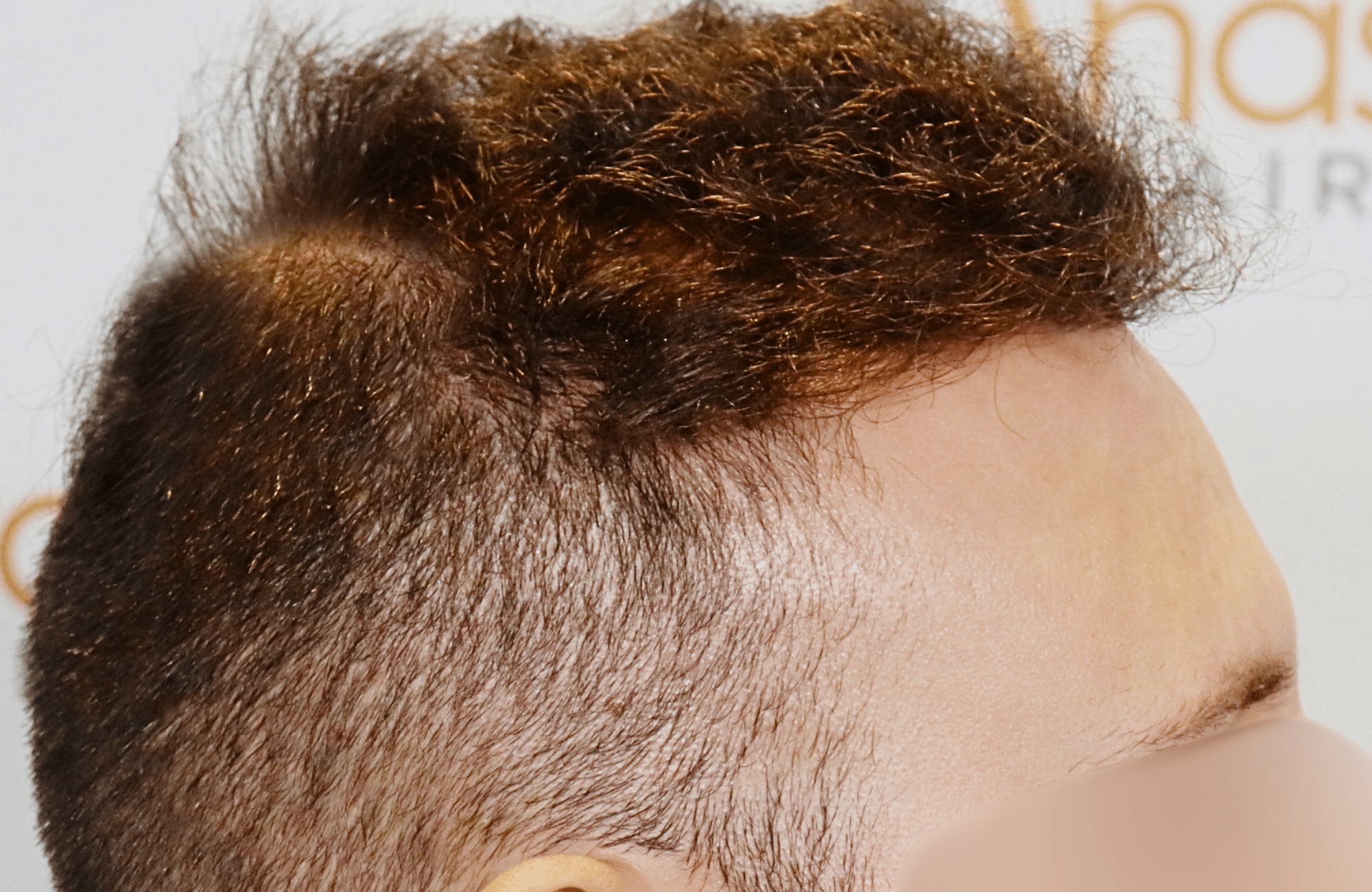 hair transplant result 1800 fus stage 5 frontal