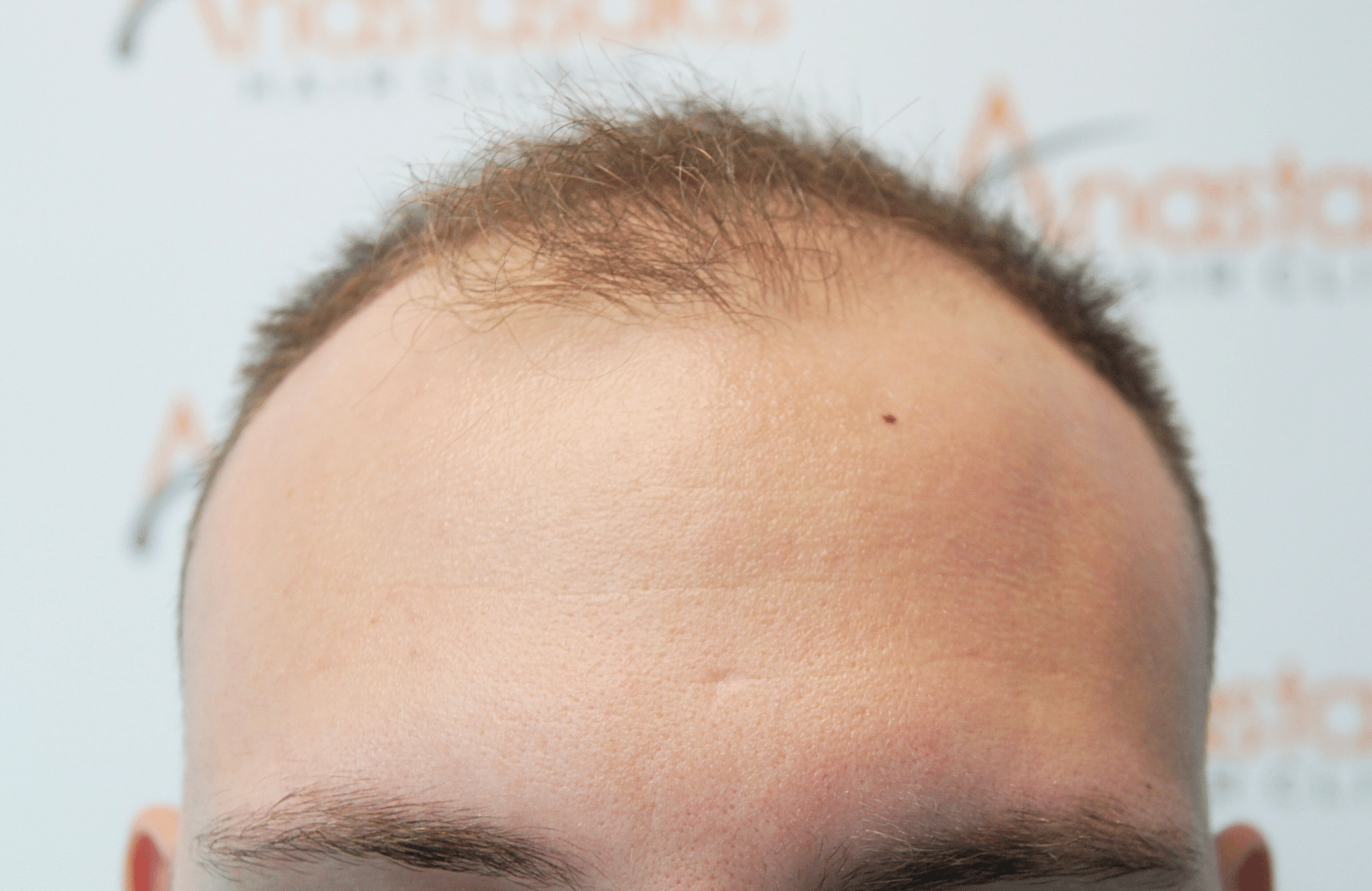 hair transplant result 1800 fus stage 5 frontal