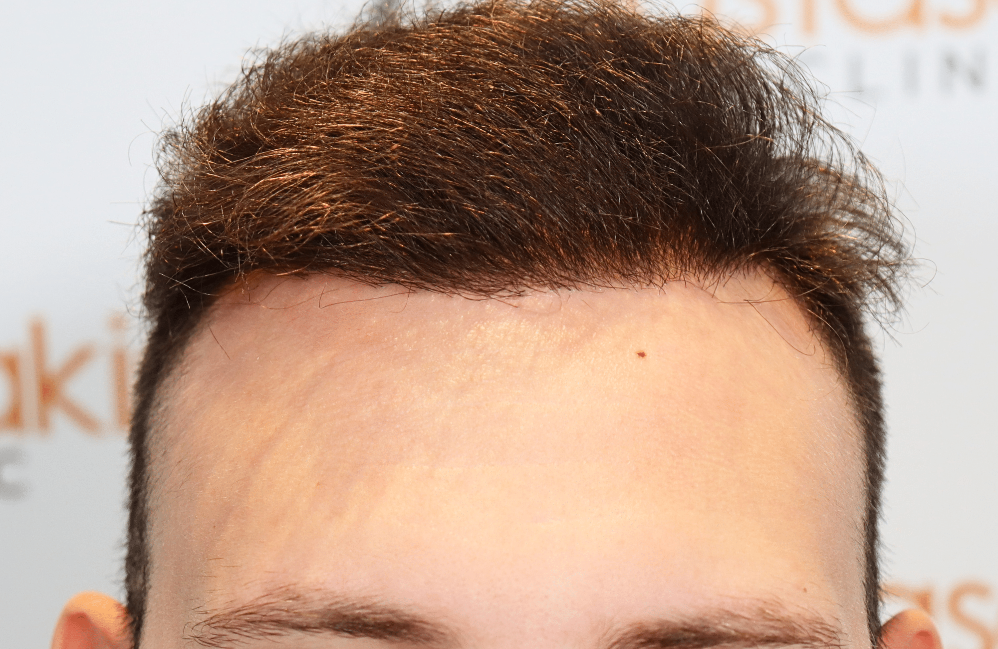 hair transplant result 1800 fus stage 5 frontal