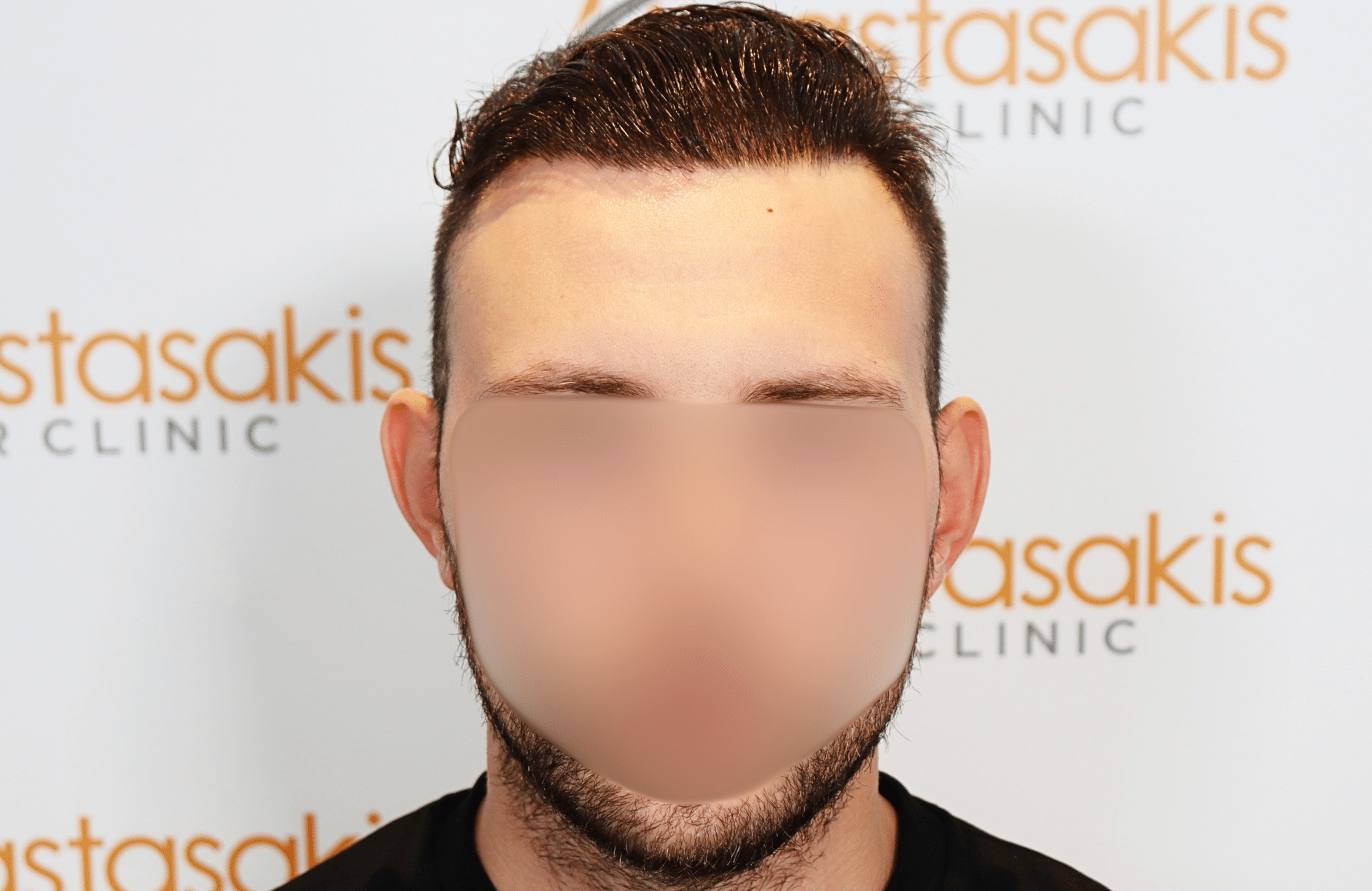 hair transplant result 1800 fus stage 5 frontal