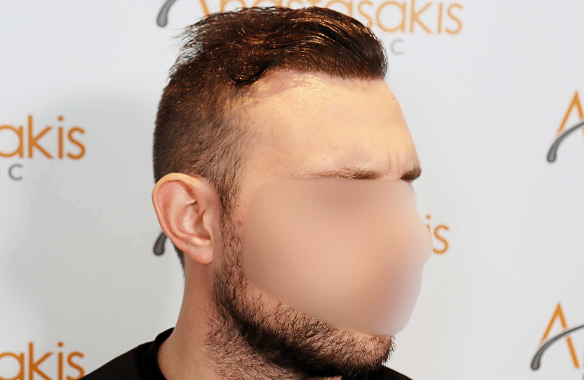 hair transplant result 1800 fus stage 5 frontal