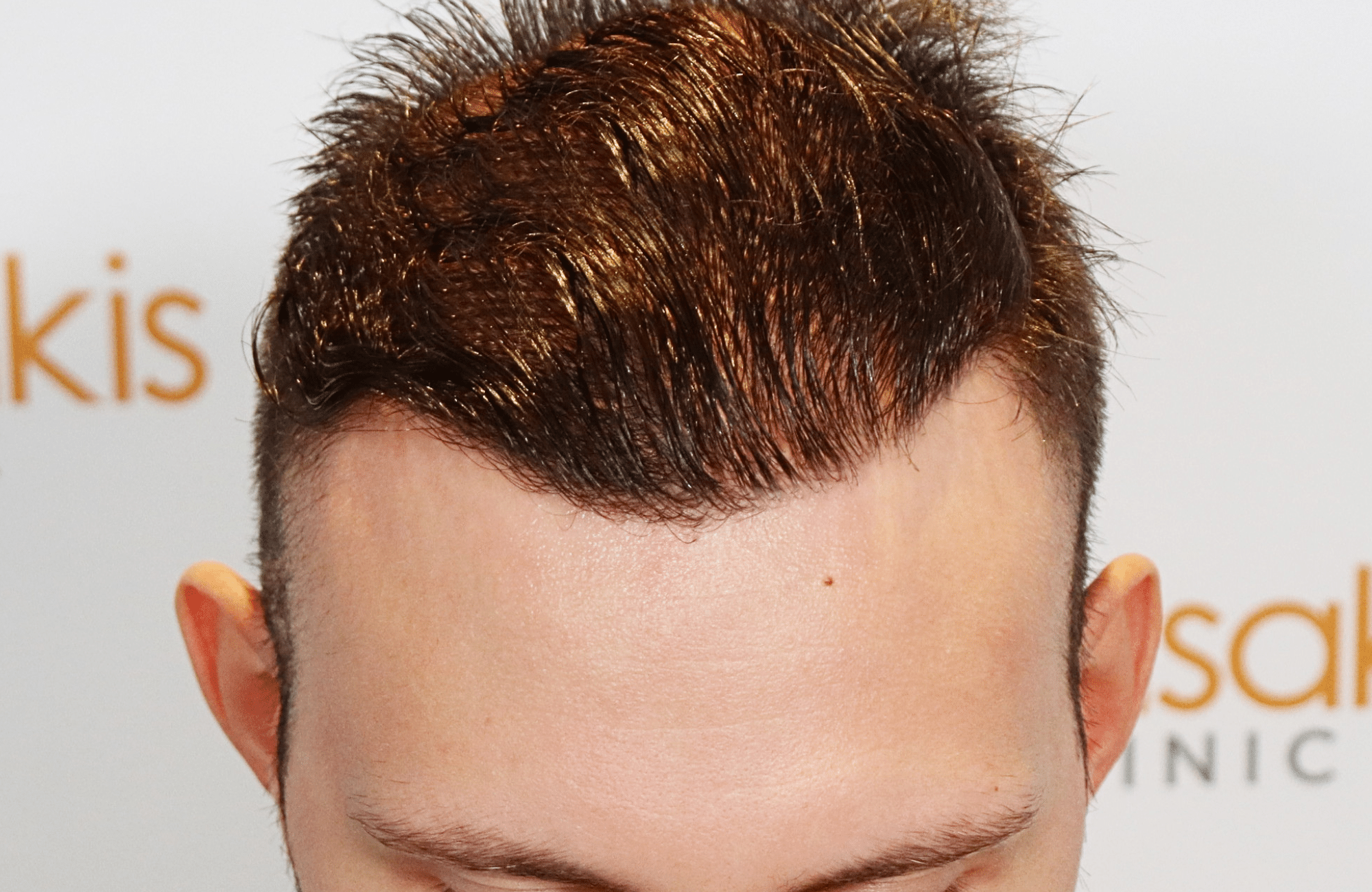 hair transplant result 1800 fus stage 5 frontal
