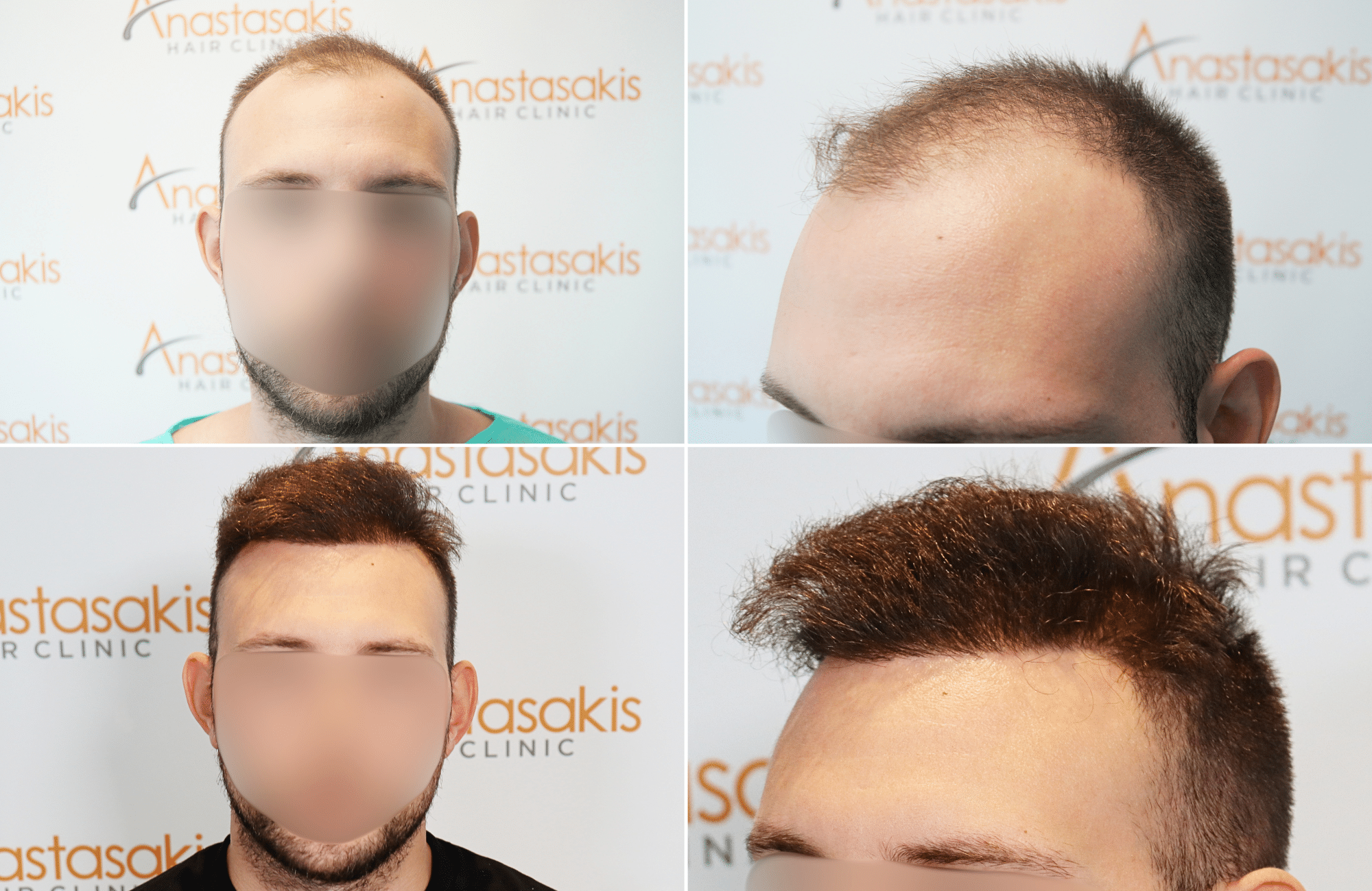 https://www.anastasakishairclinic.gr/portfolio/apotelesma-metamosxefsis-mallion-anastasakis-hair-clinic-168/