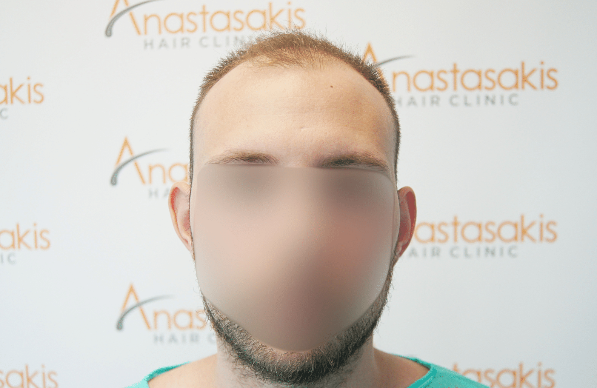 hair transplant result 1800 fus stage 5 frontal