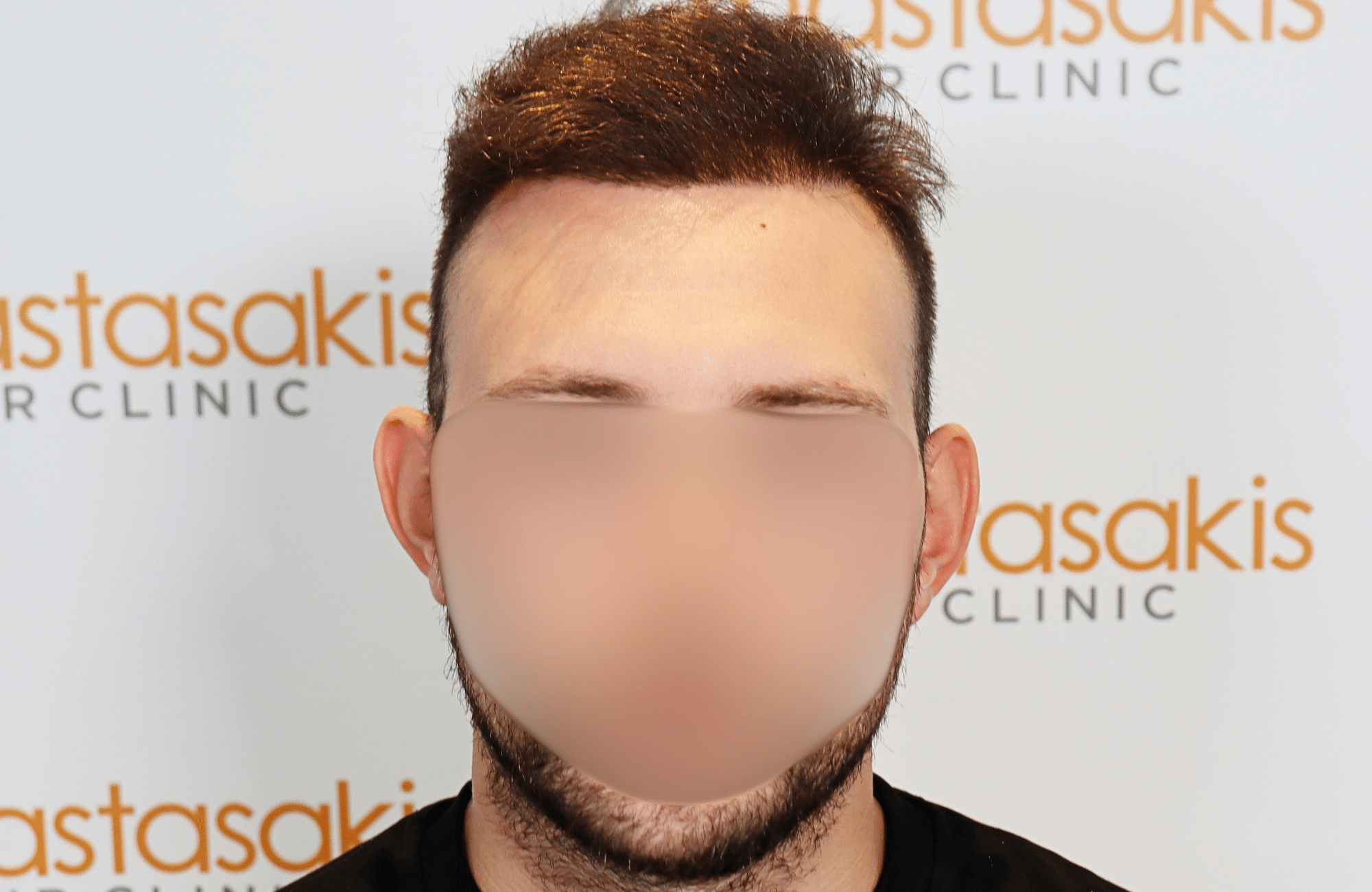 hair transplant result 1800 fus stage 5 frontal