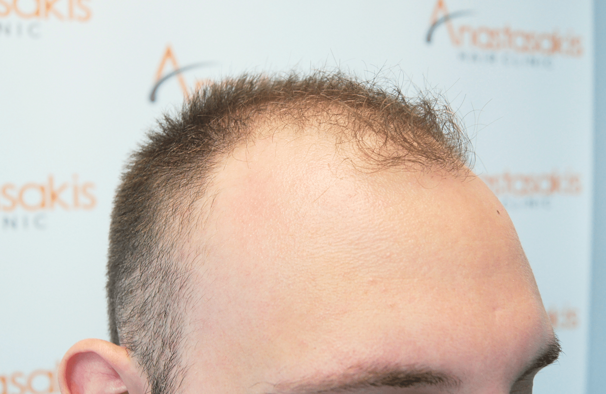 hair transplant result 1800 fus stage 5 frontal