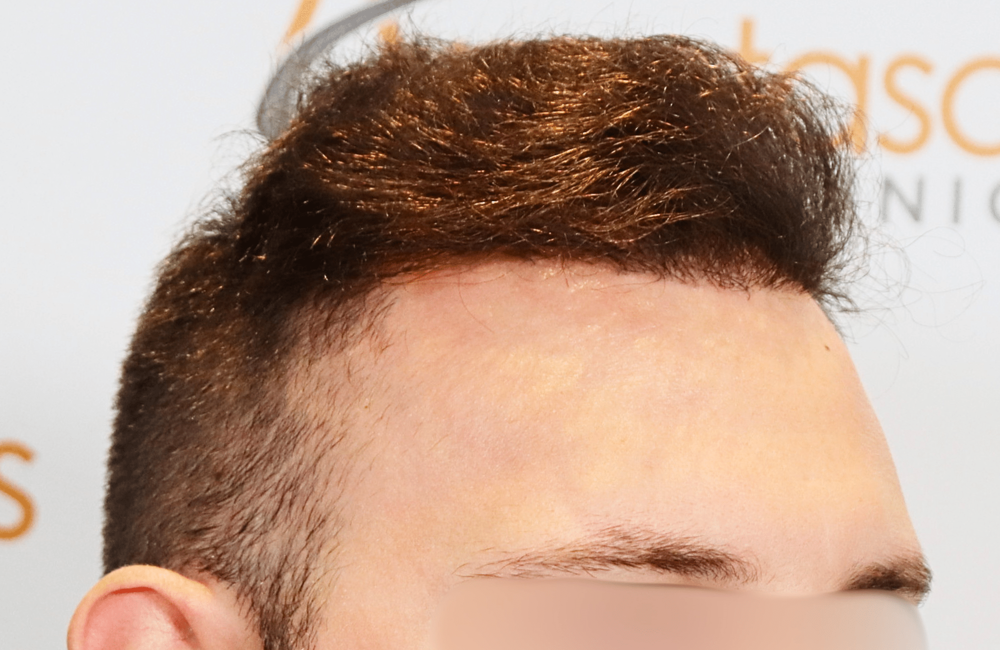 hair transplant result 1800 fus stage 5 frontal