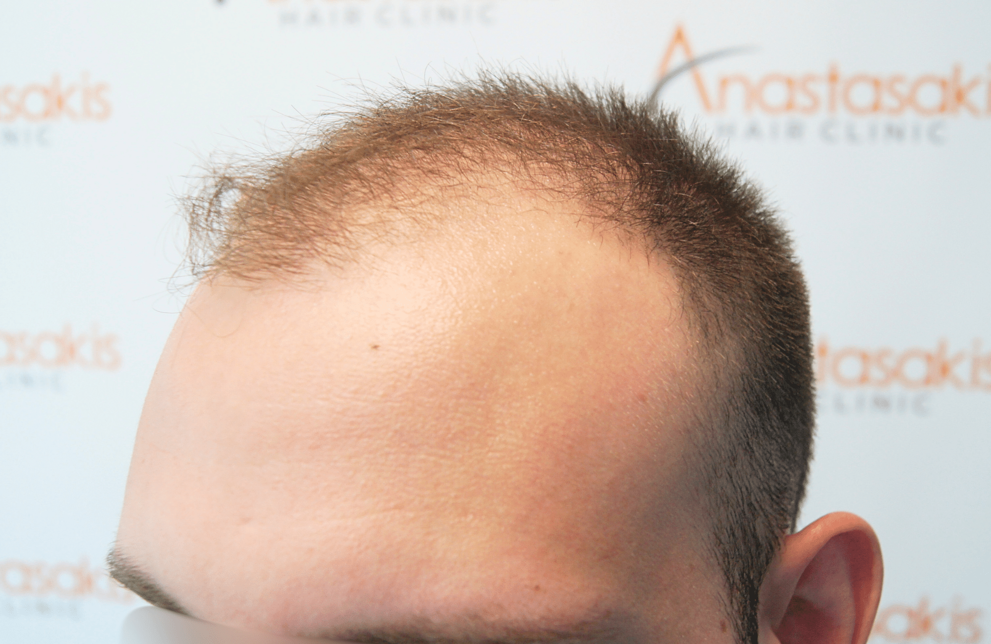 hair transplant result 1800 fus stage 5 frontal