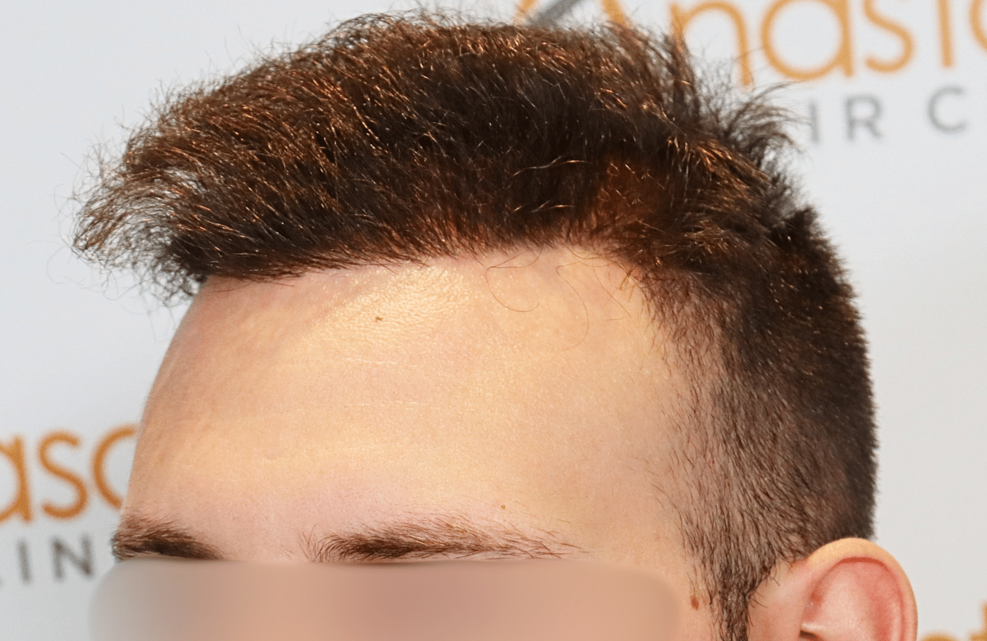 hair transplant result 1800 fus stage 5 frontal