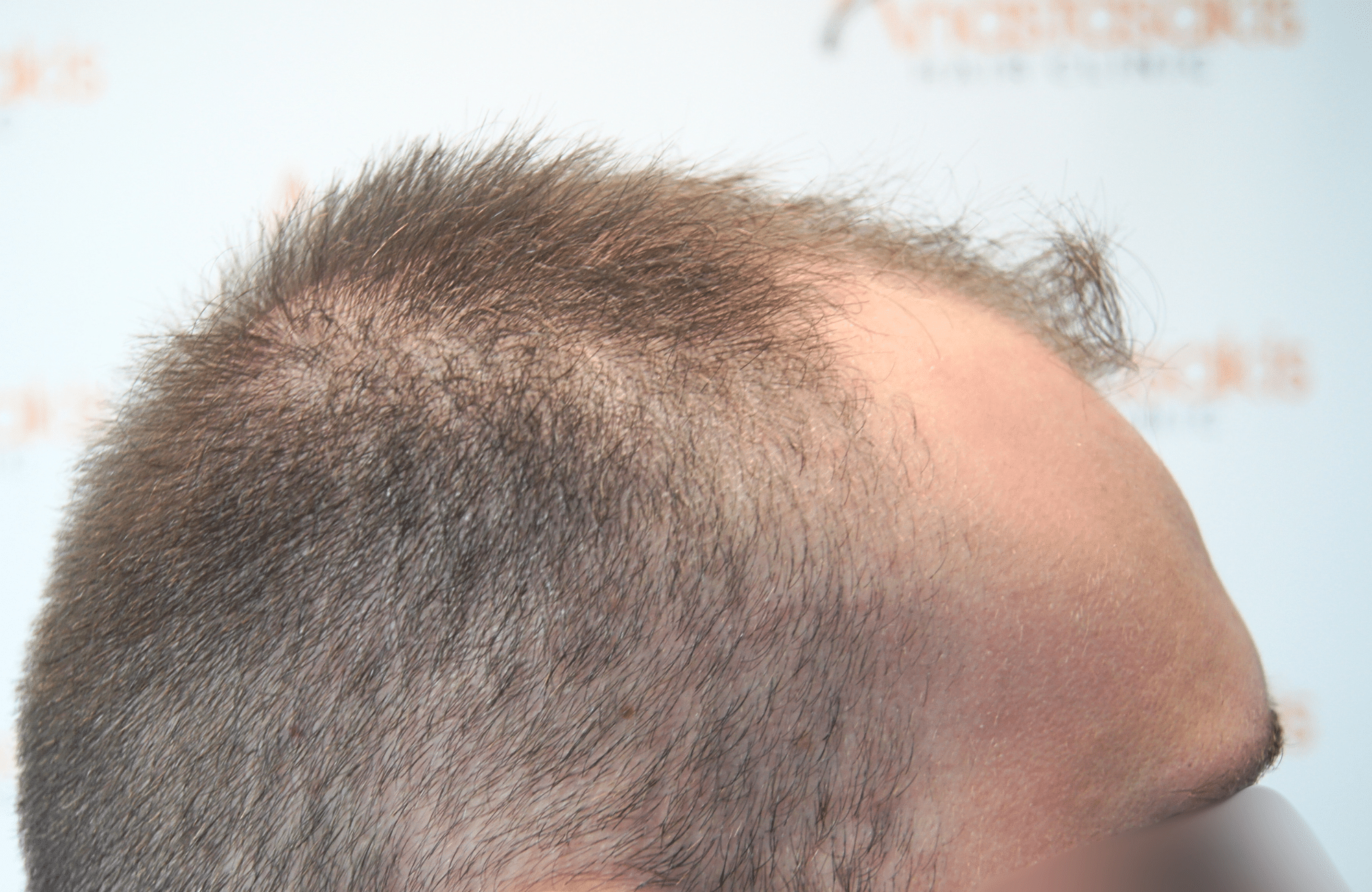 hair transplant result 1800 fus stage 5 frontal
