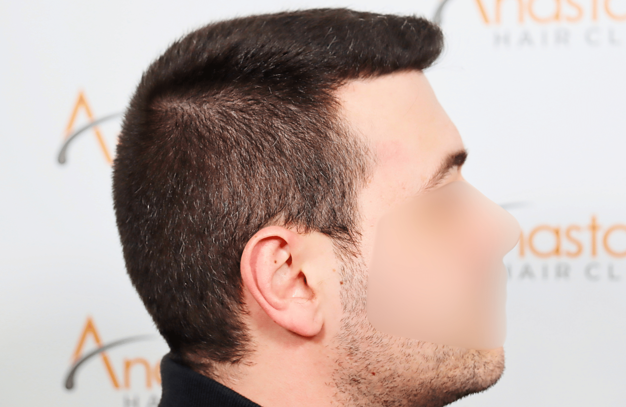 hair transplant result 1800 fus temples thick (1)