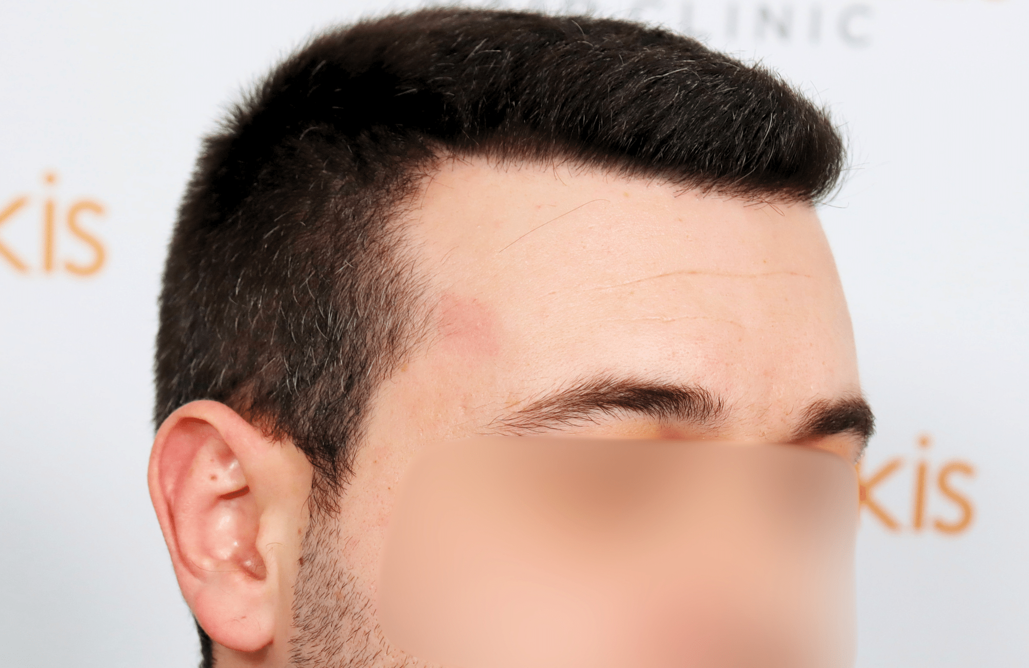 hair transplant result 1800 fus temples thick (10)