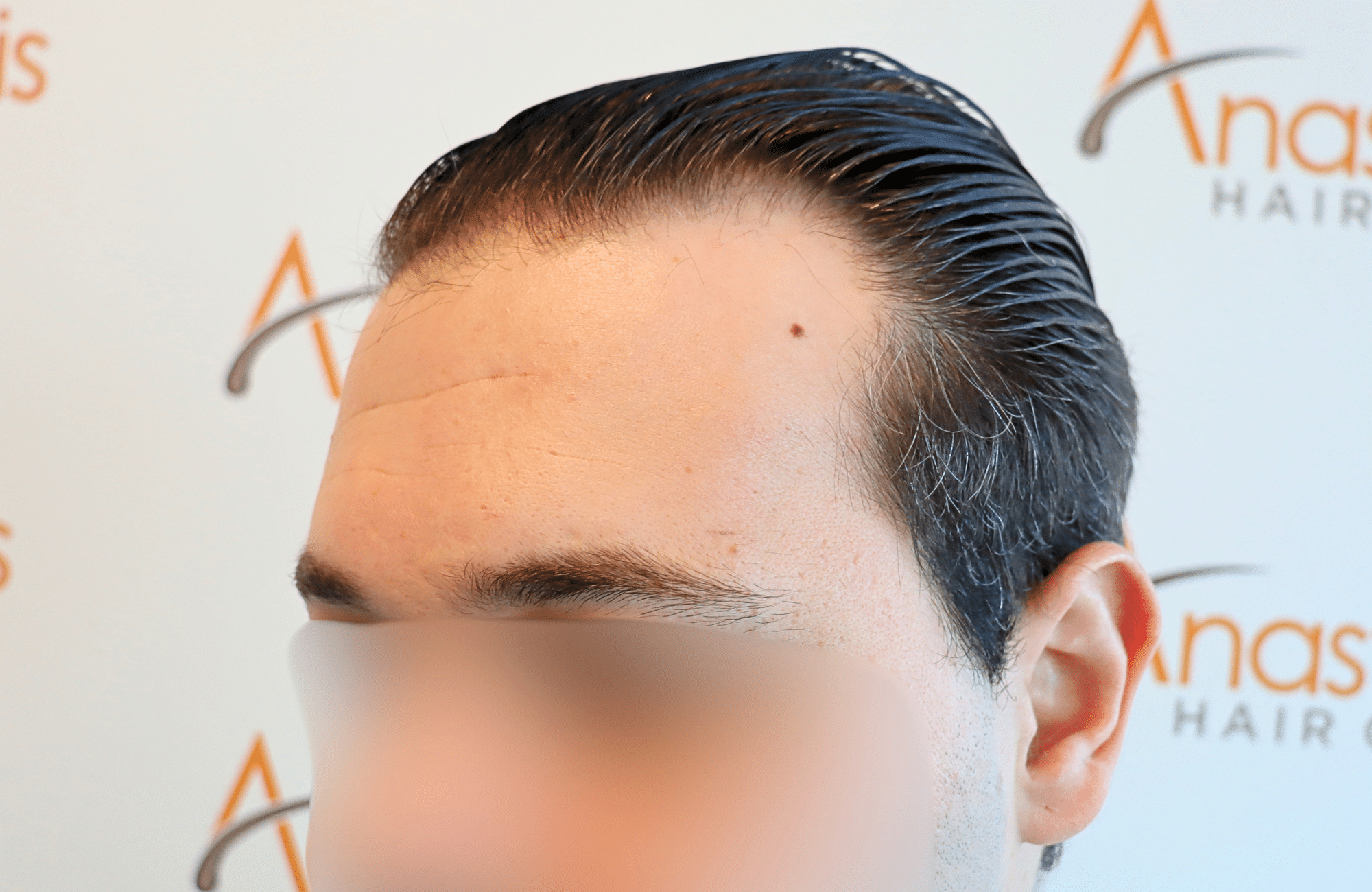 hair transplant result 1800 fus temples thick (11)