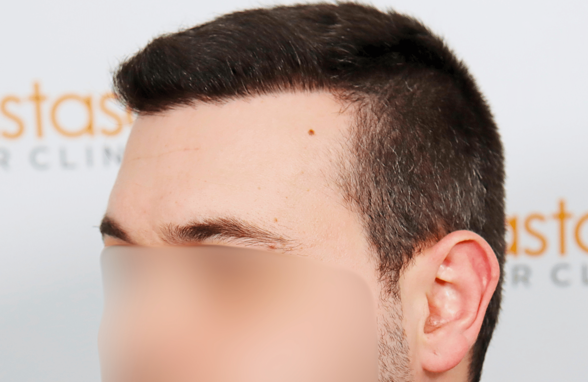 hair transplant result 1800 fus temples thick (12)