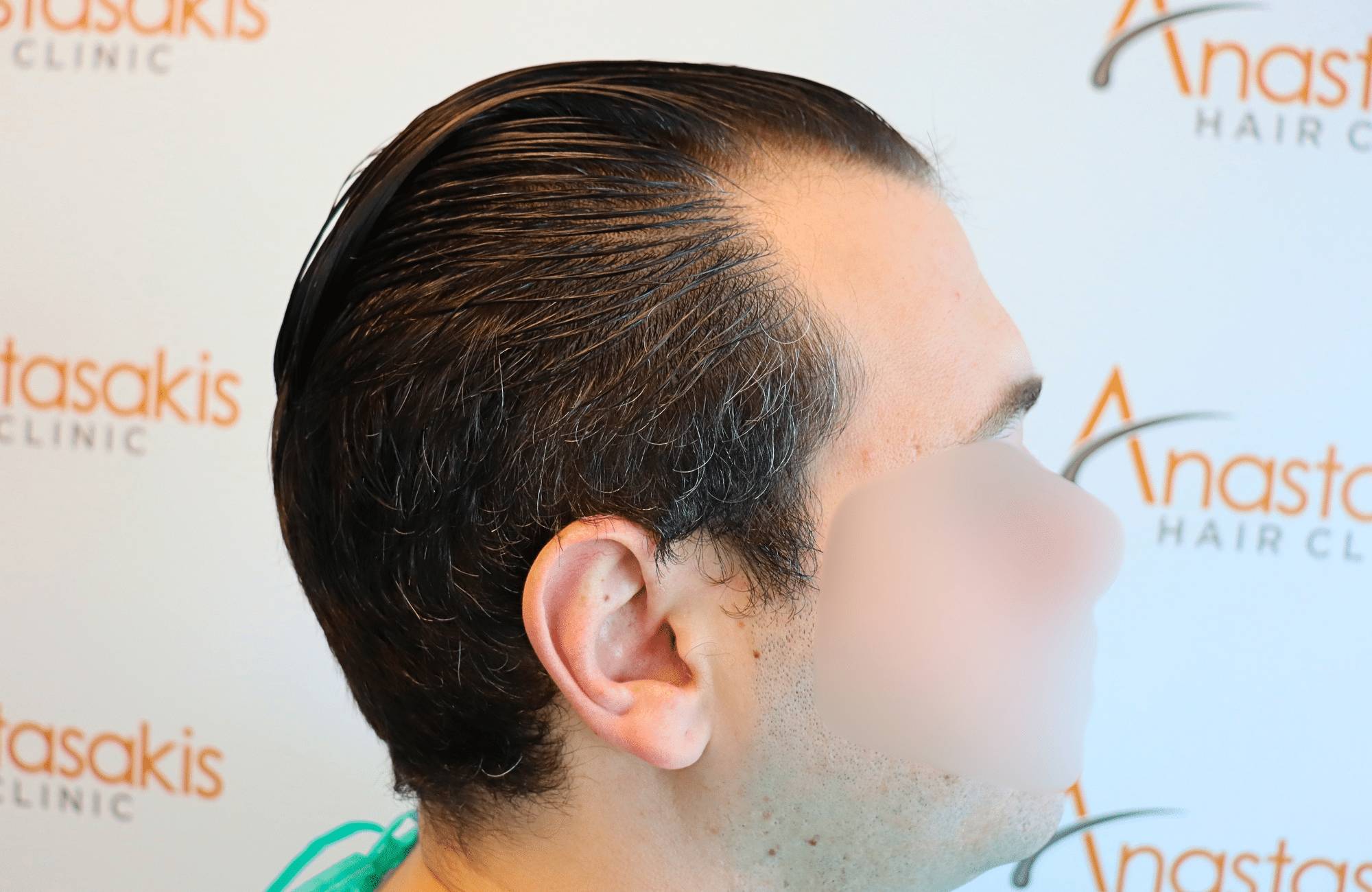 hair transplant result 1800 fus temples thick (13)