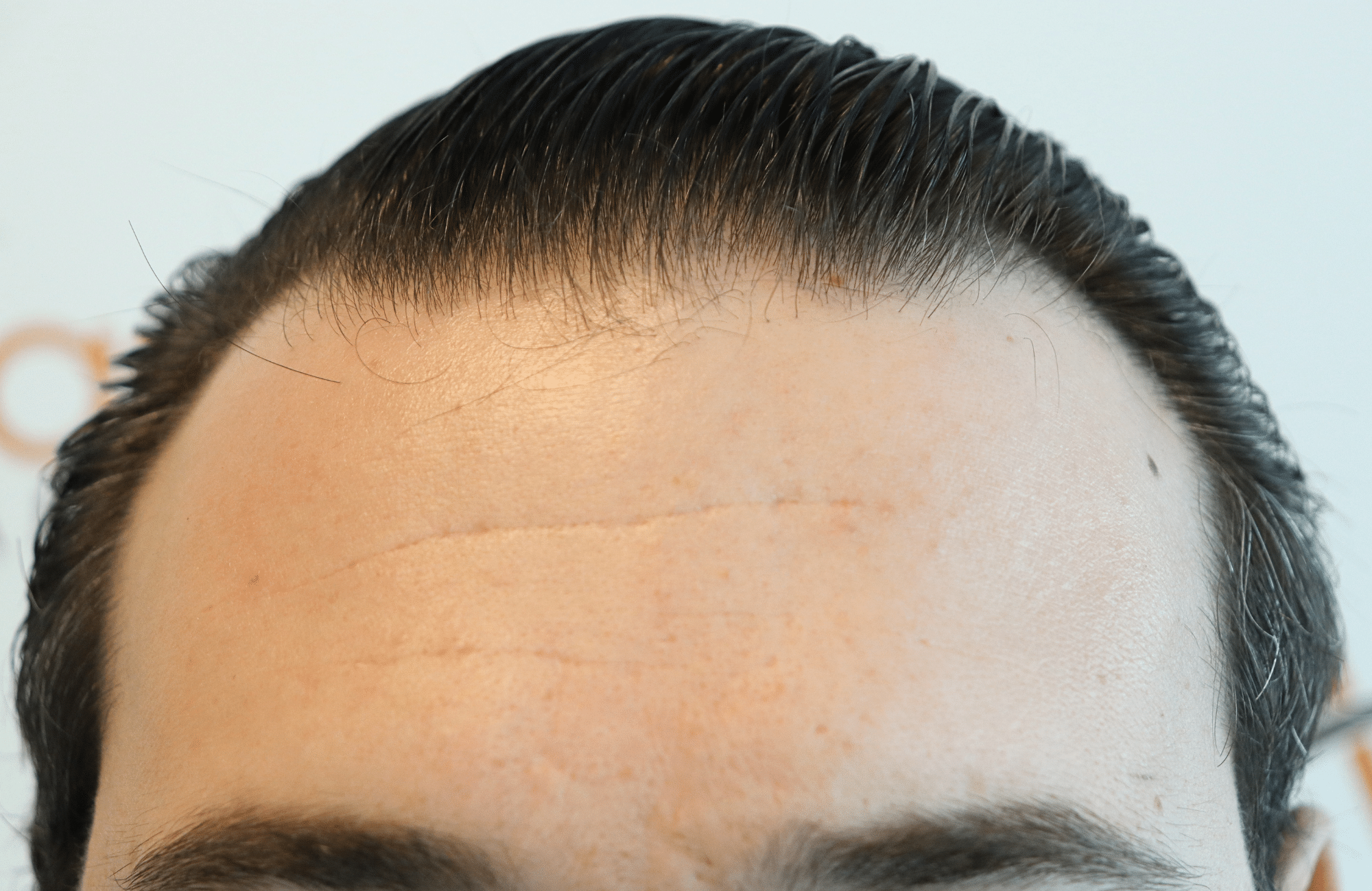 hair transplant result 1800 fus temples thick (4)