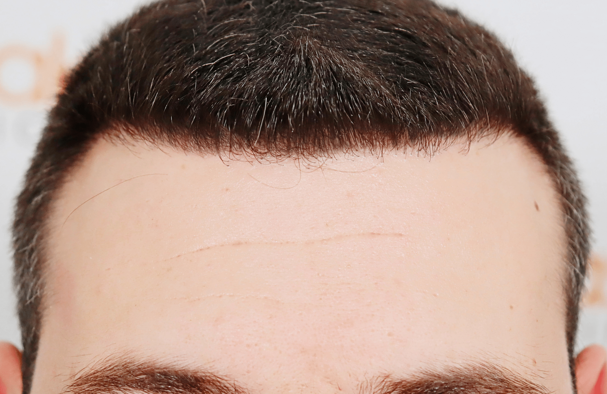 hair transplant result 1800 fus temples thick (4)
