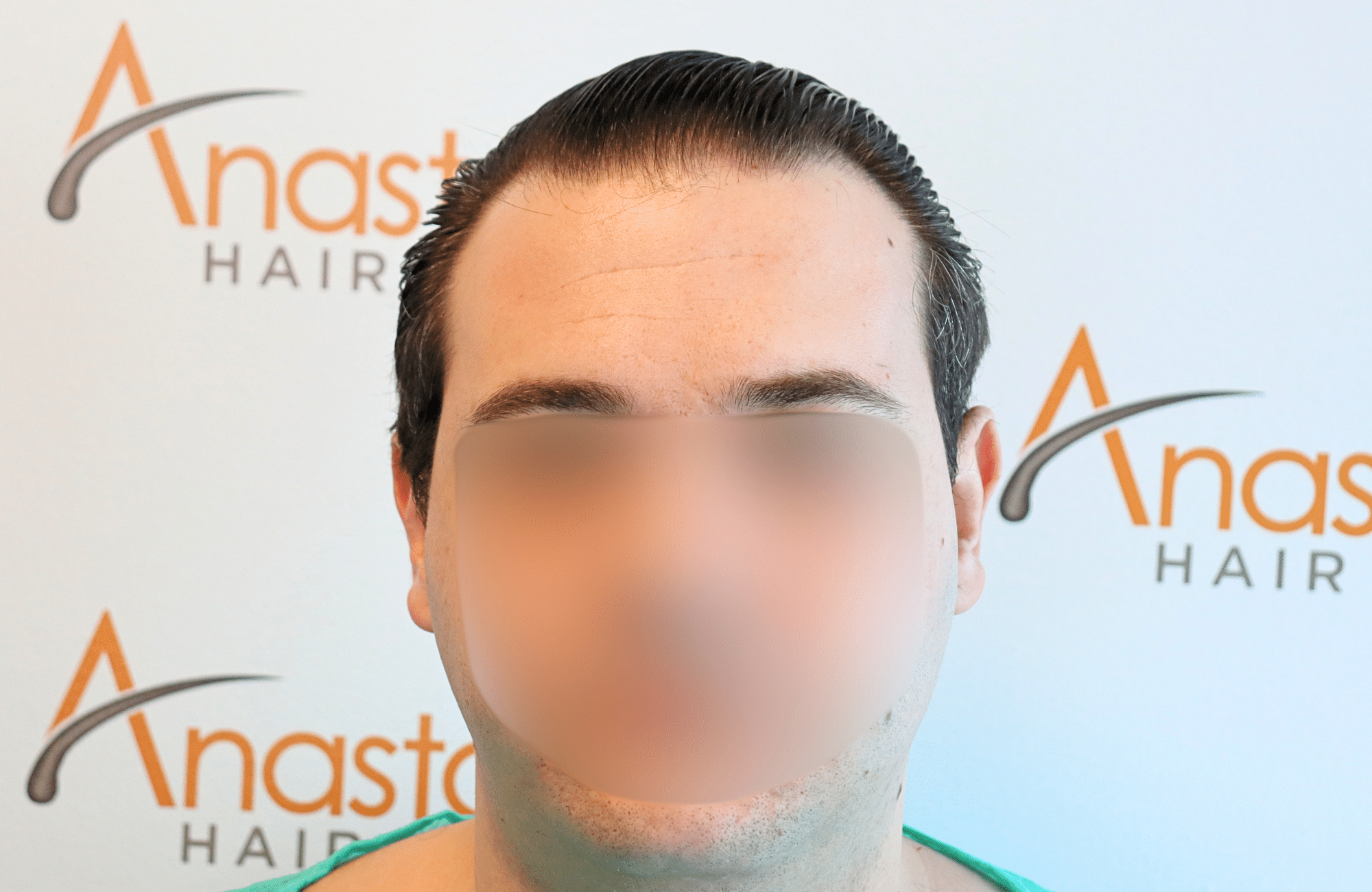 hair transplant result 1800 fus temples thick (7)