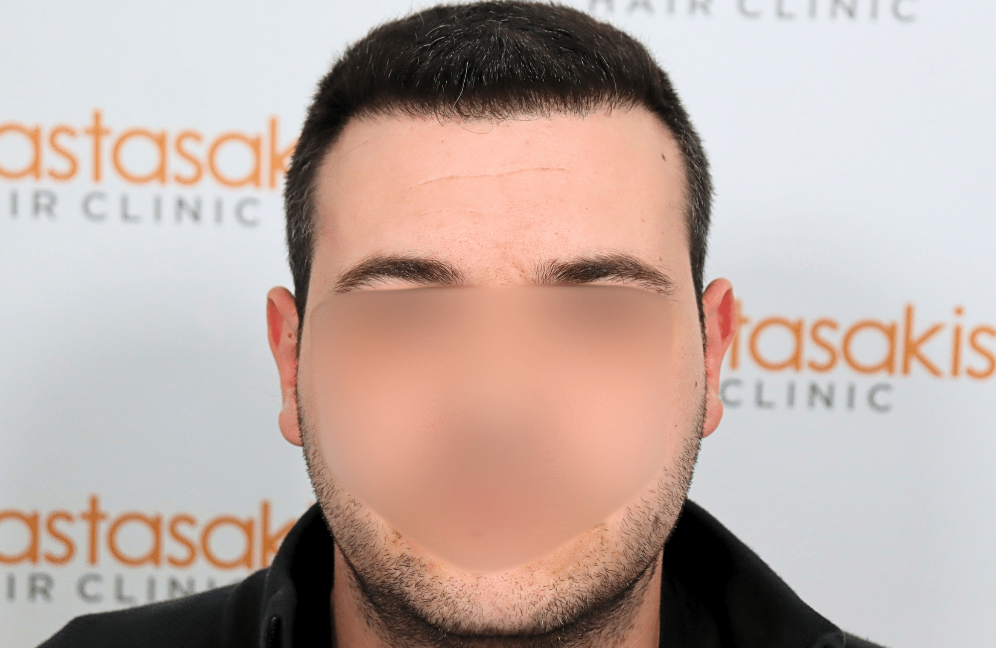 hair transplant result 1800 fus temples thick (8)