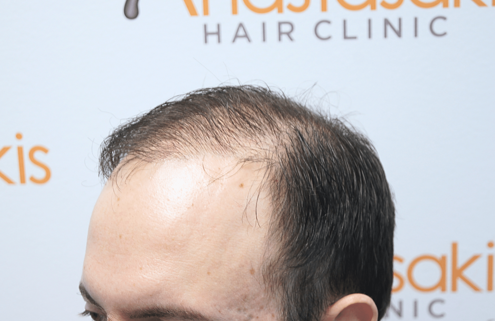 hair transplant result