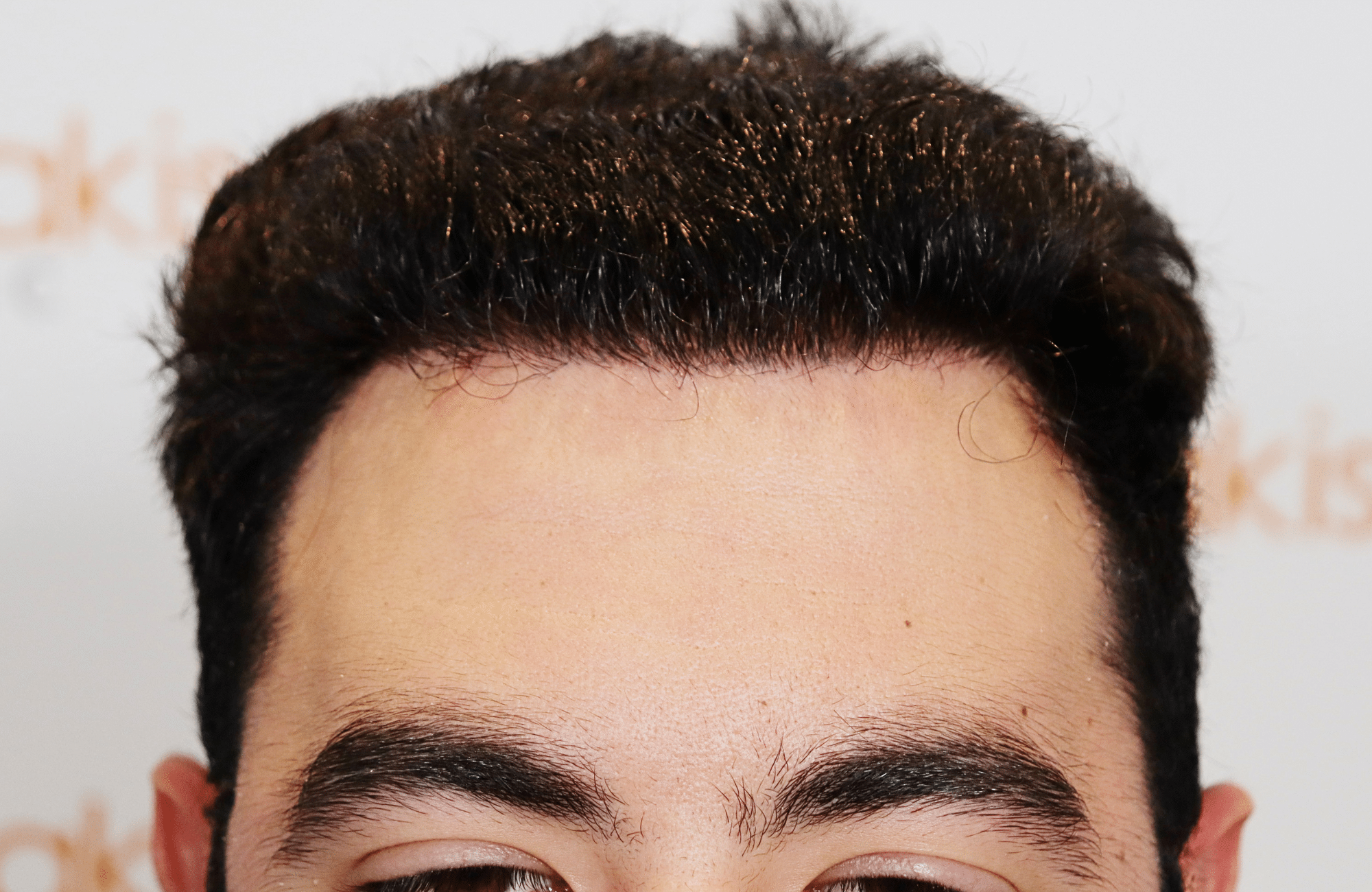 hair transplant result 2000 fus (11)