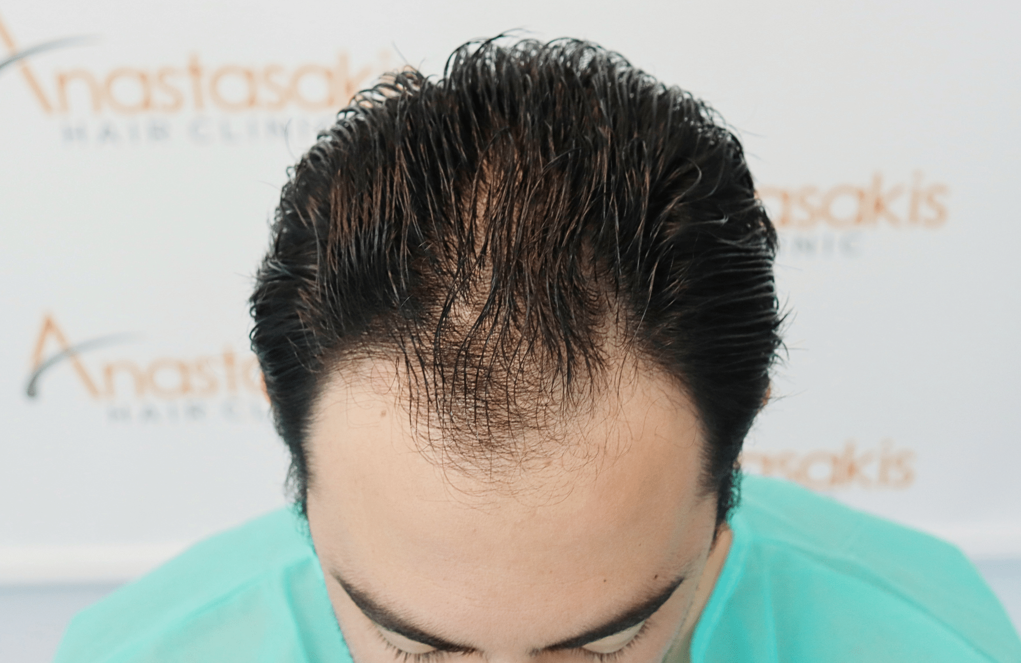 hair transplant result 2000 fus (12)