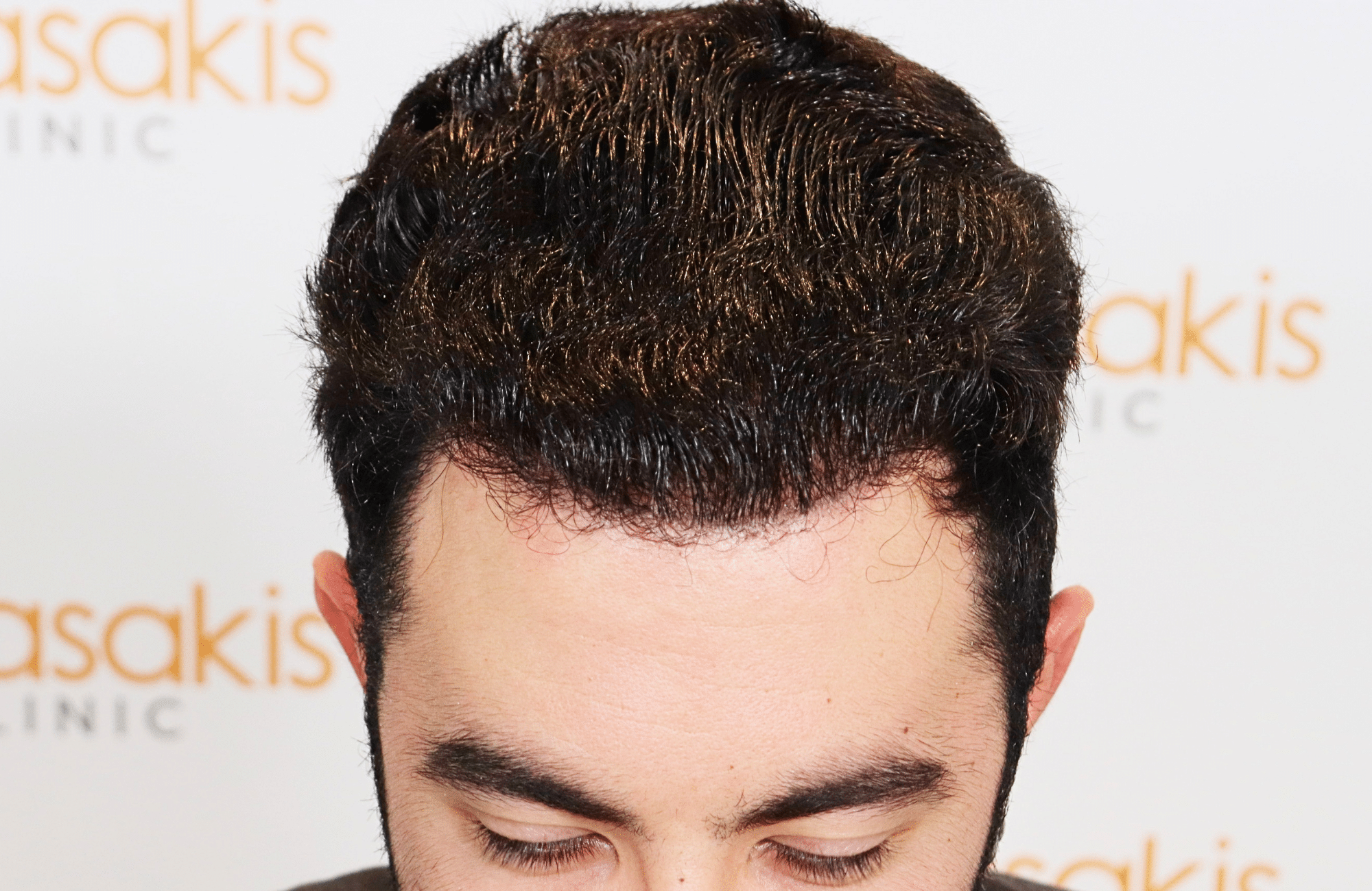 hair transplant result 2000 fus (13)