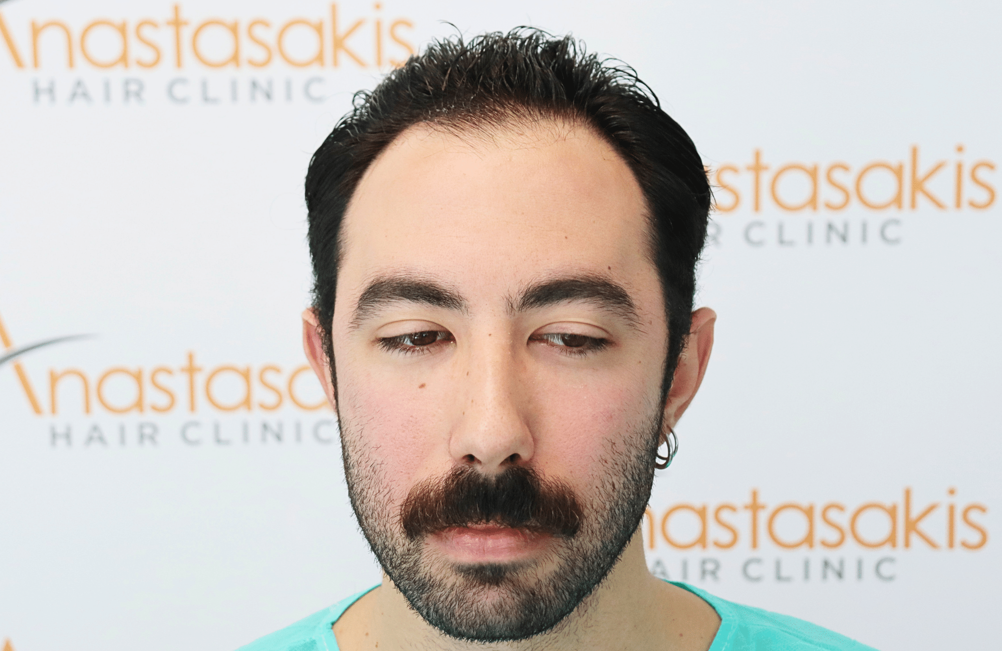 hair transplant result 2000 fus (14)