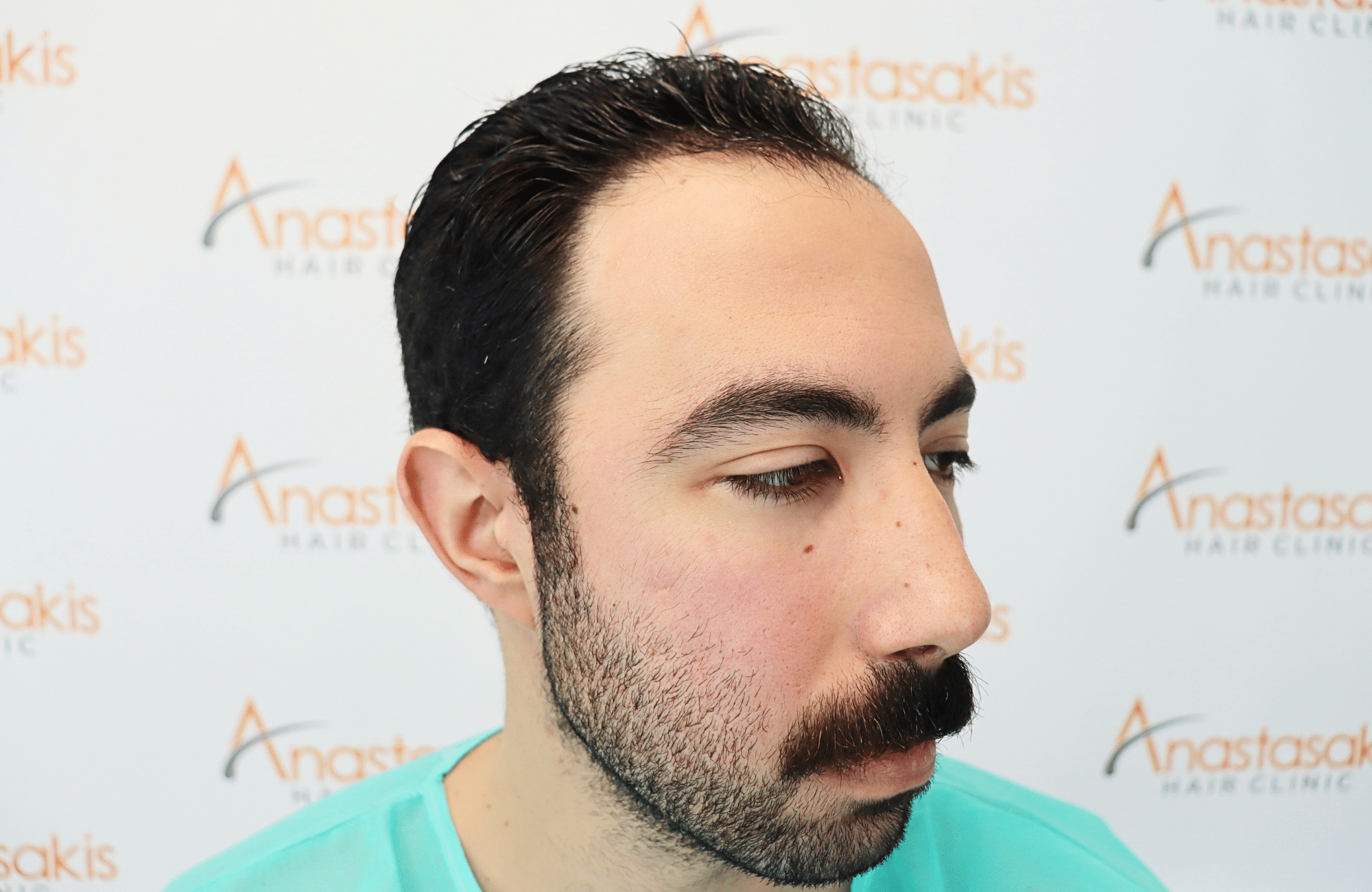 hair transplant result 2000 fus (2)