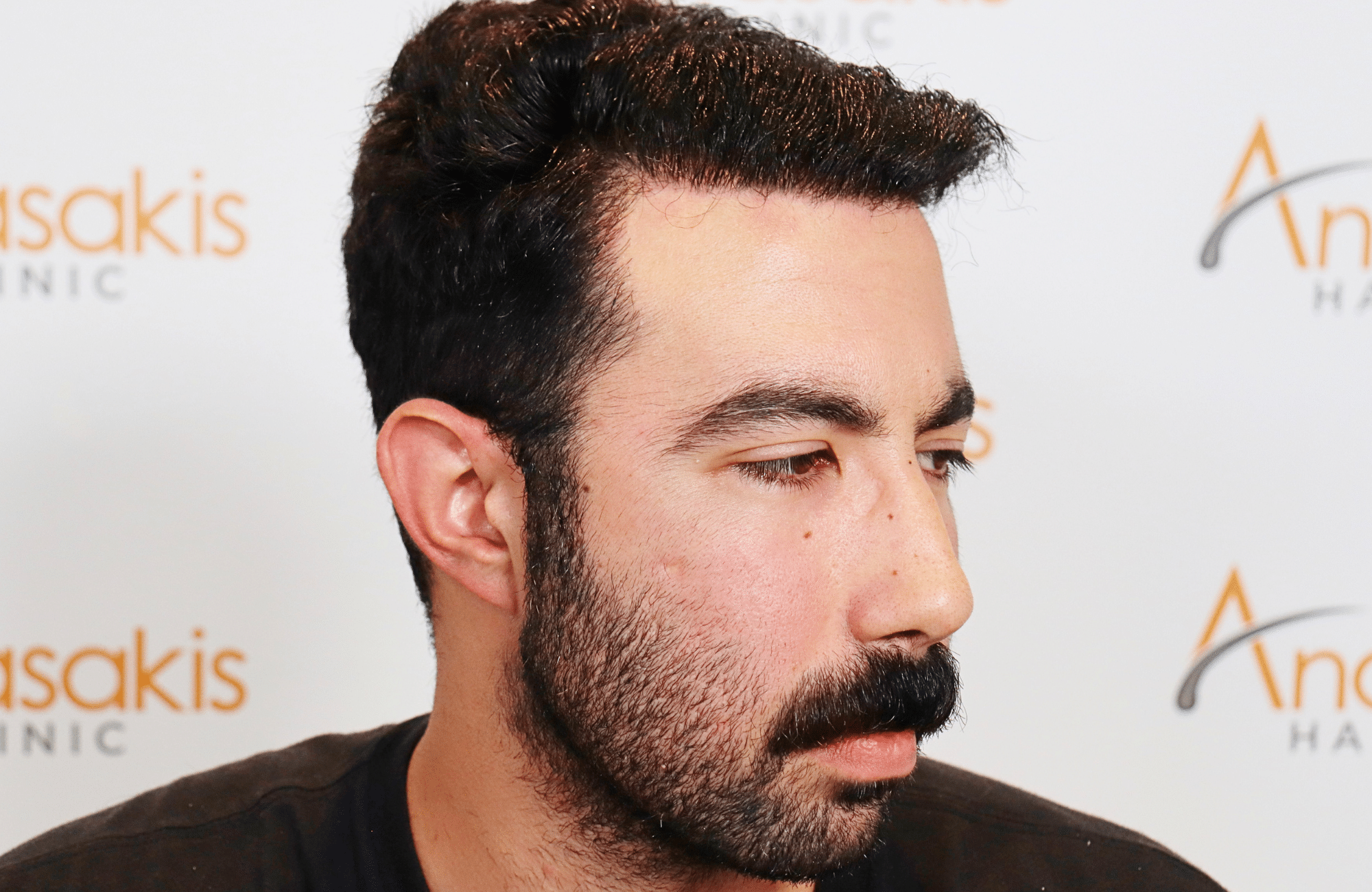 hair transplant result 2000 fus (3)