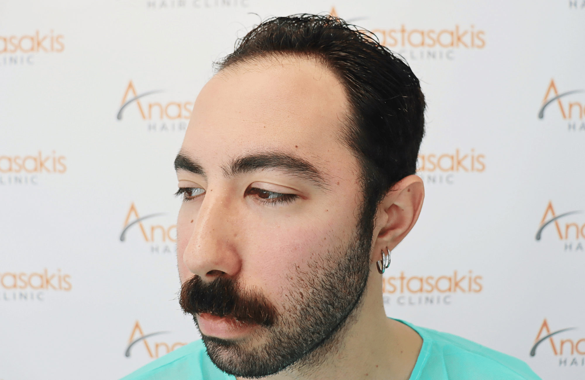 hair transplant result 2000 fus (4)
