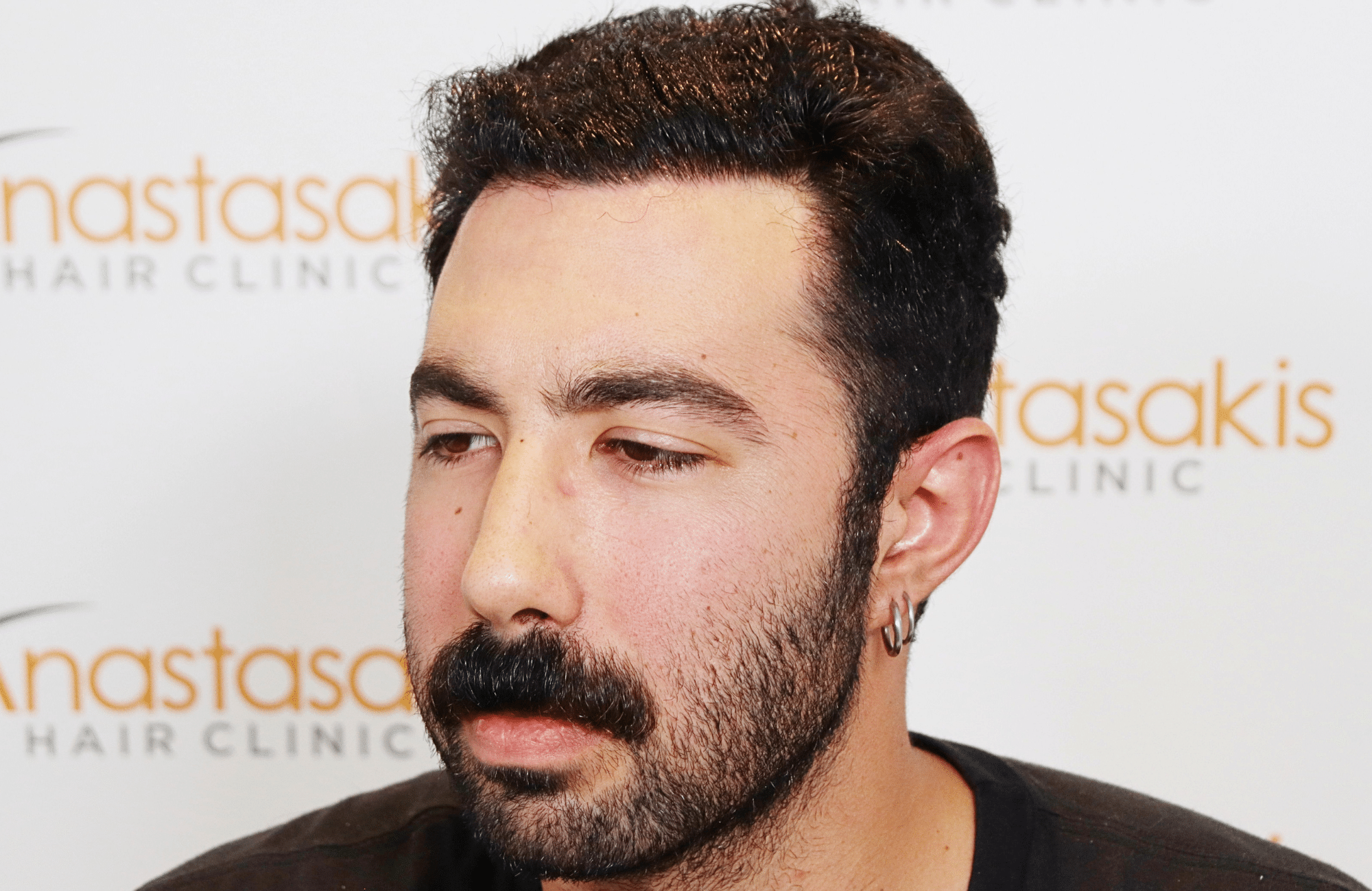 hair transplant result 2000 fus (5)