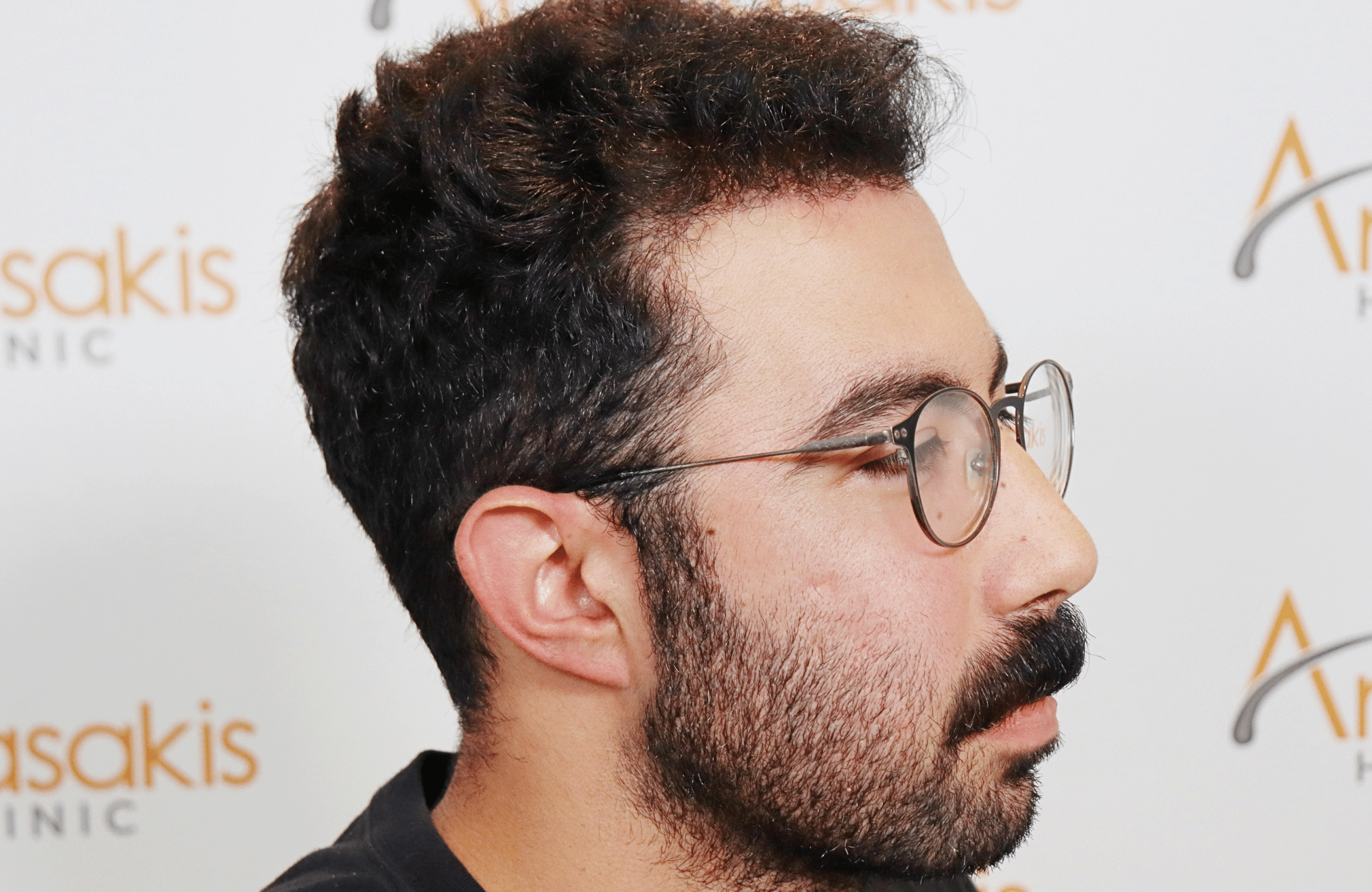 hair transplant result 2000 fus (7)