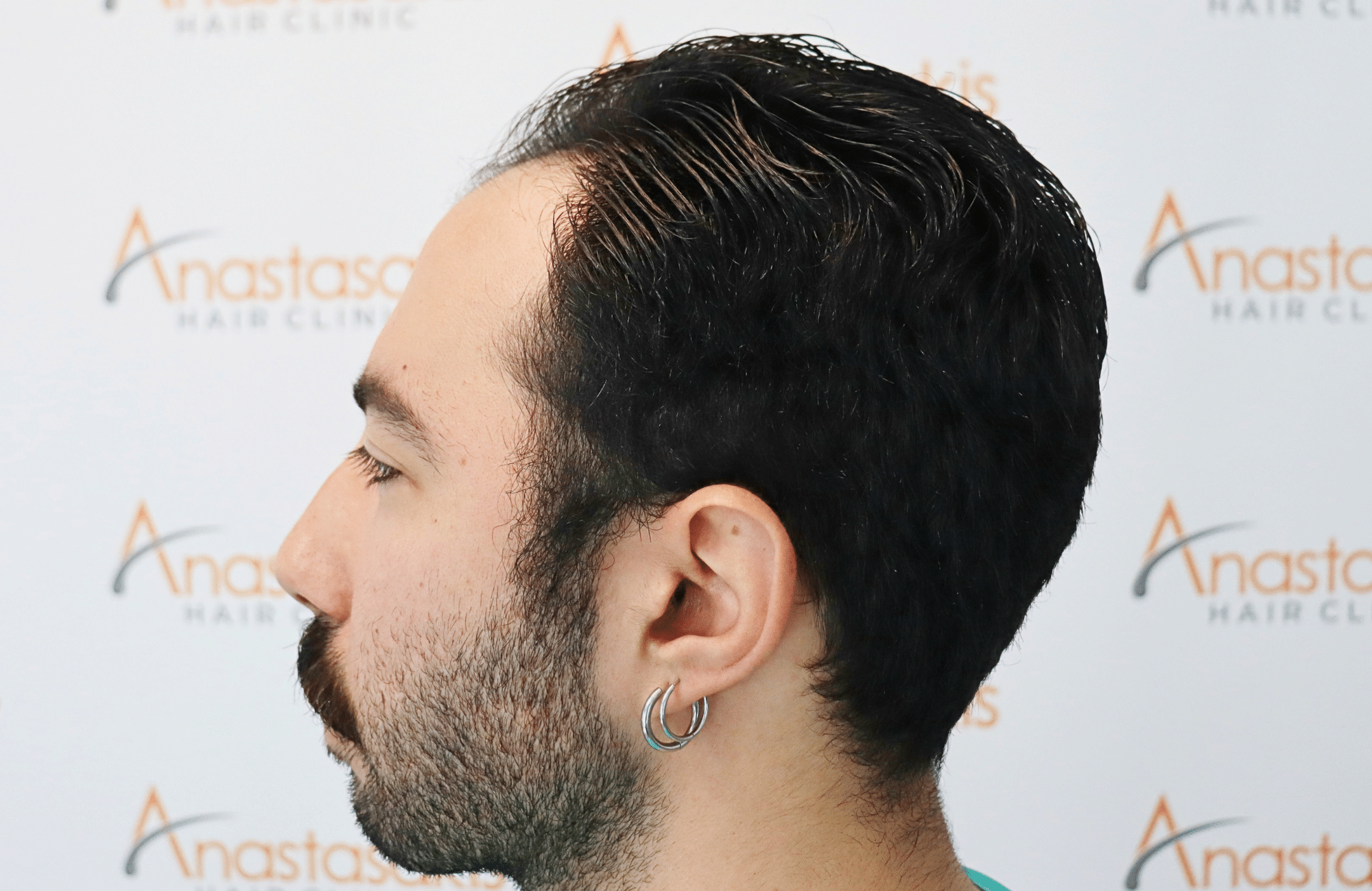 hair transplant result 2000 fus (8)
