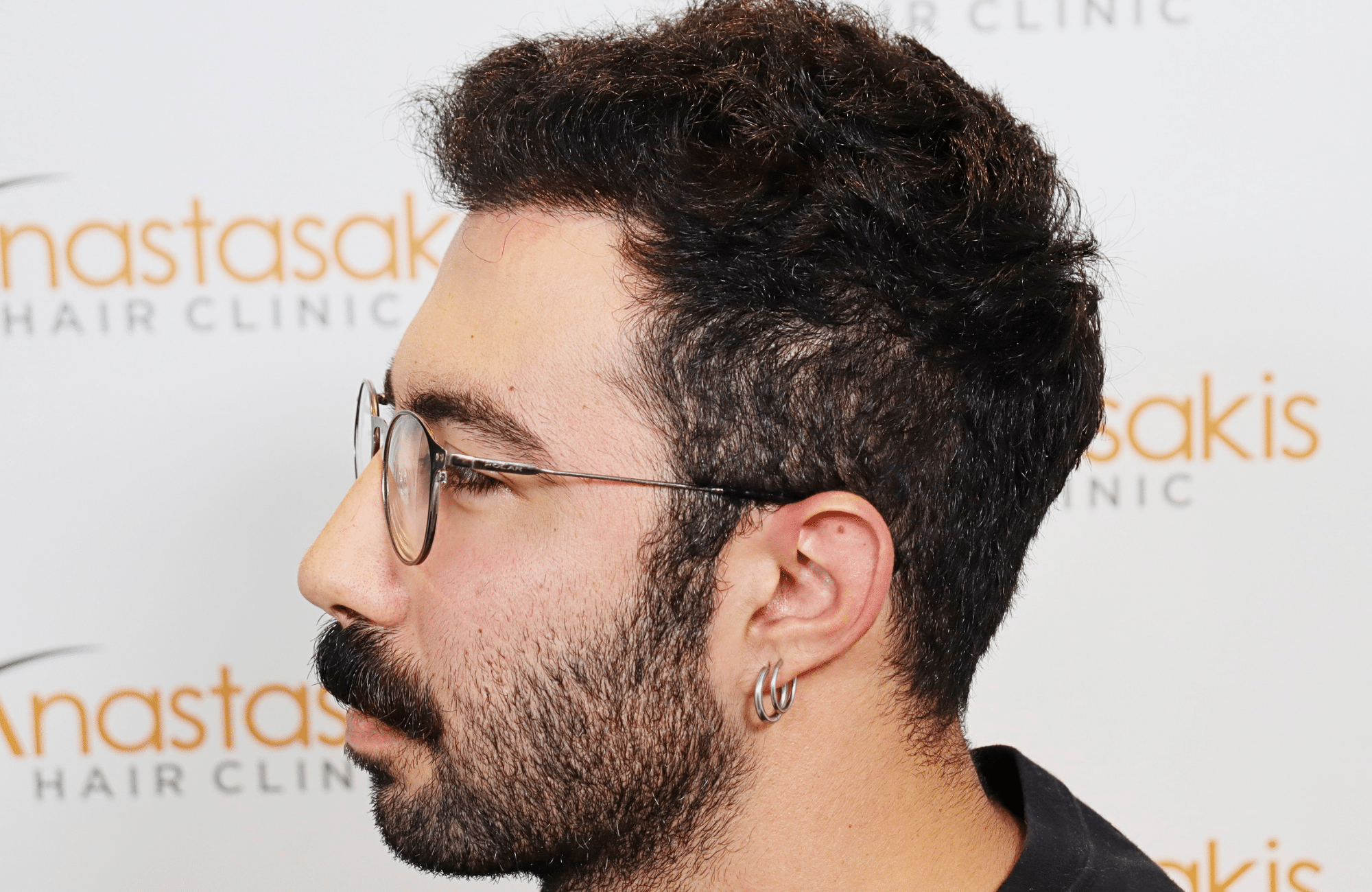 hair transplant result 2000 fus (9)