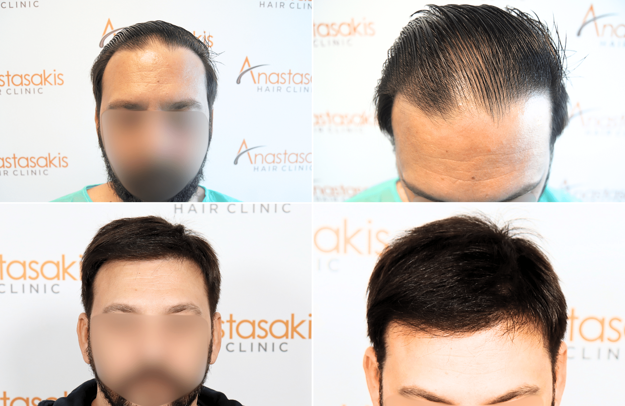 https://www.anastasakishairclinic.gr/portfolio/apotelesma-metamosxefsis-mallion-anastasakis-hair-clinic-167/