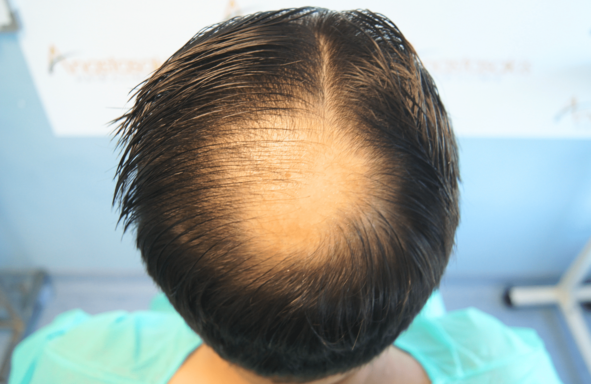 hair transplant result 2000 fus stage 4 crown thick