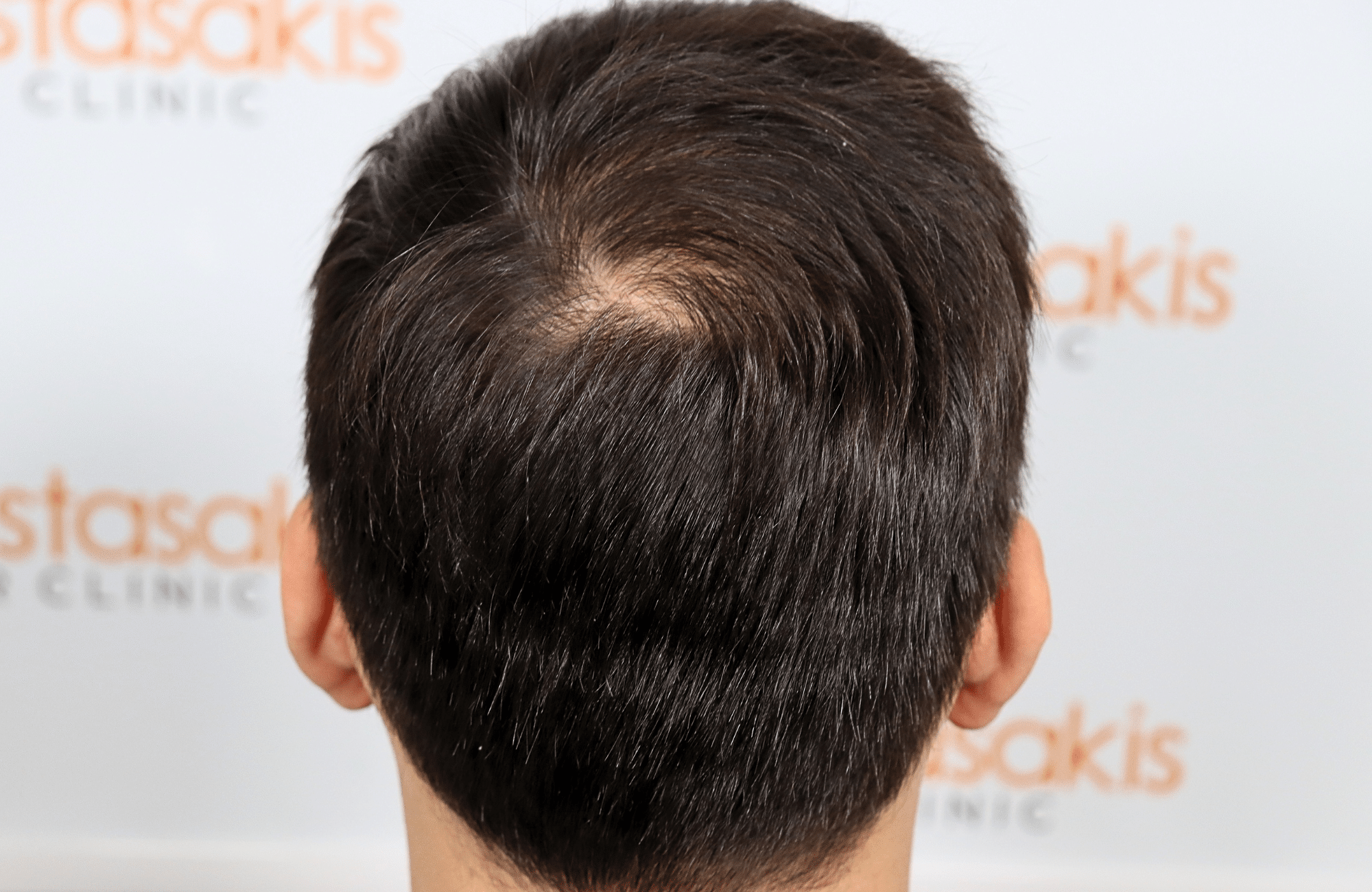 hair transplant result 2000 fus stage 4 crown thick