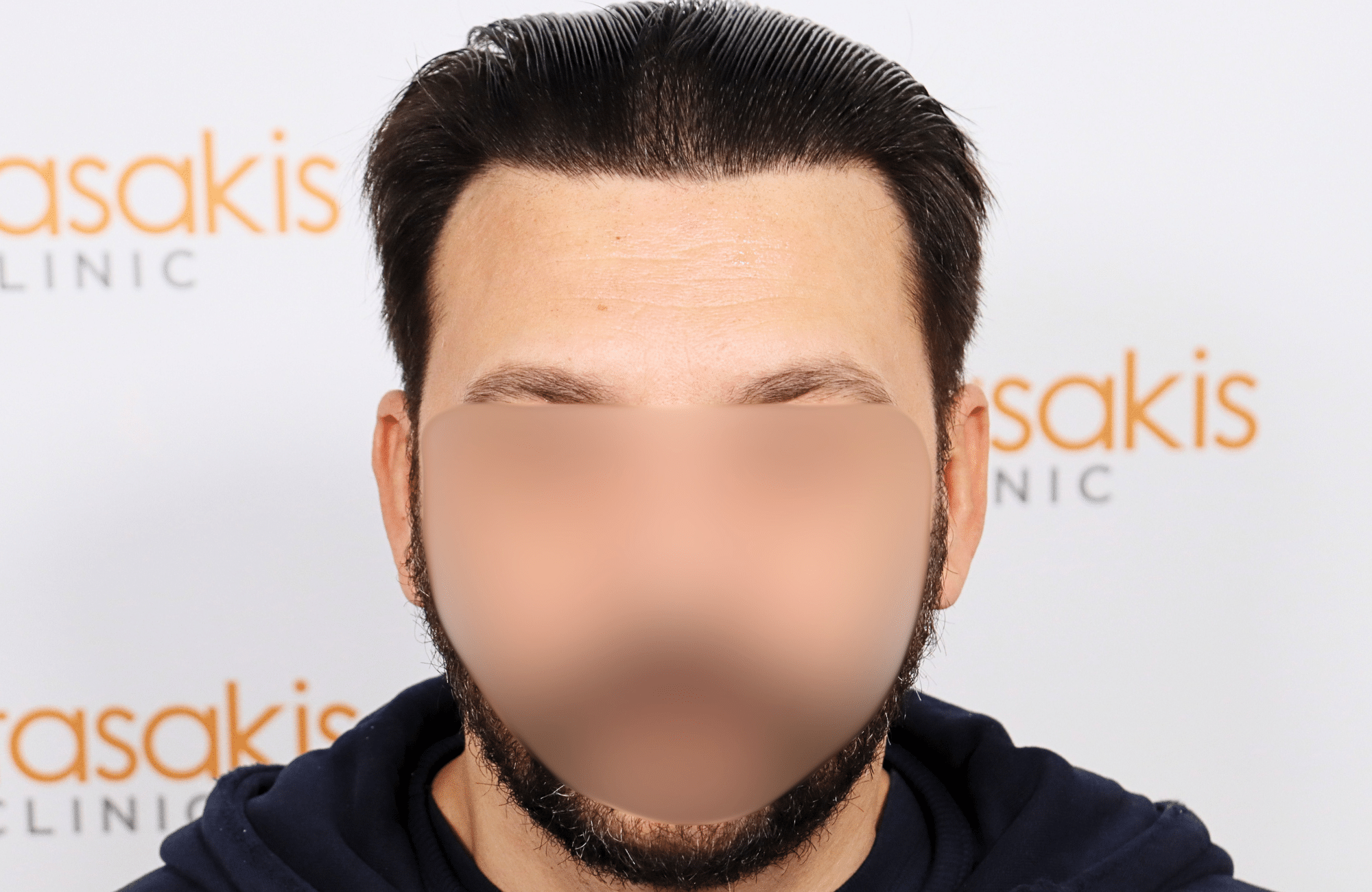 hair transplant result 2000 fus stage 4 crown thick